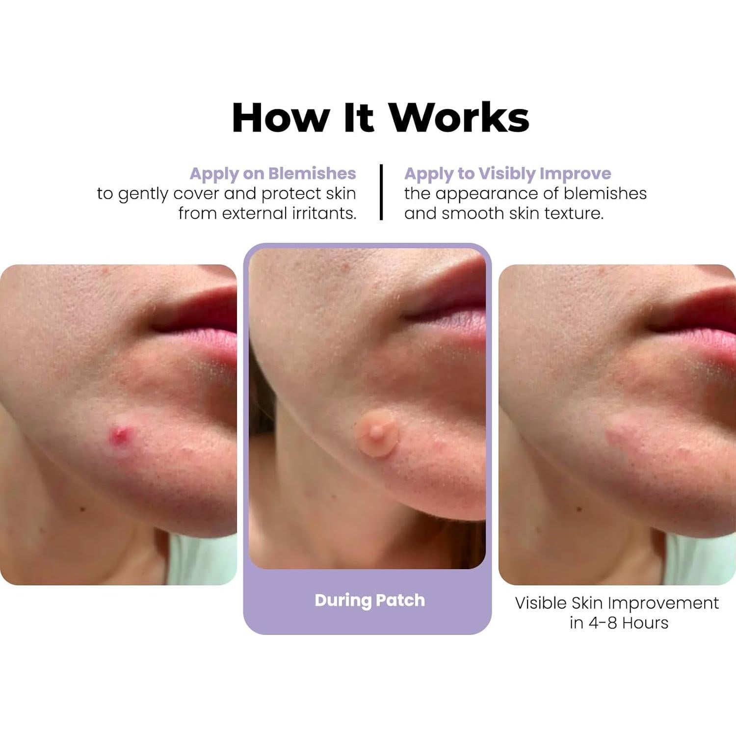 Parches para Granitos RoselynBoutique 300 Piezas Hidrocoloide