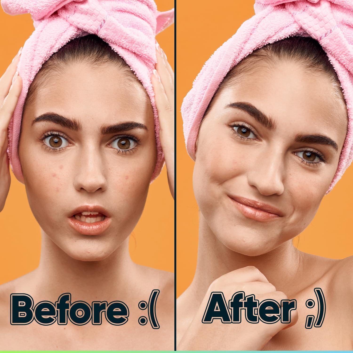 Parches Hidrocoloides para Granos BIORICA 216 Pcs con Aceite de Árbol de Té