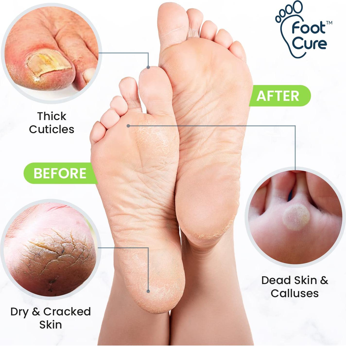 Kit de Remojo de Pies y Gel Removedor de Callos Foot Cure