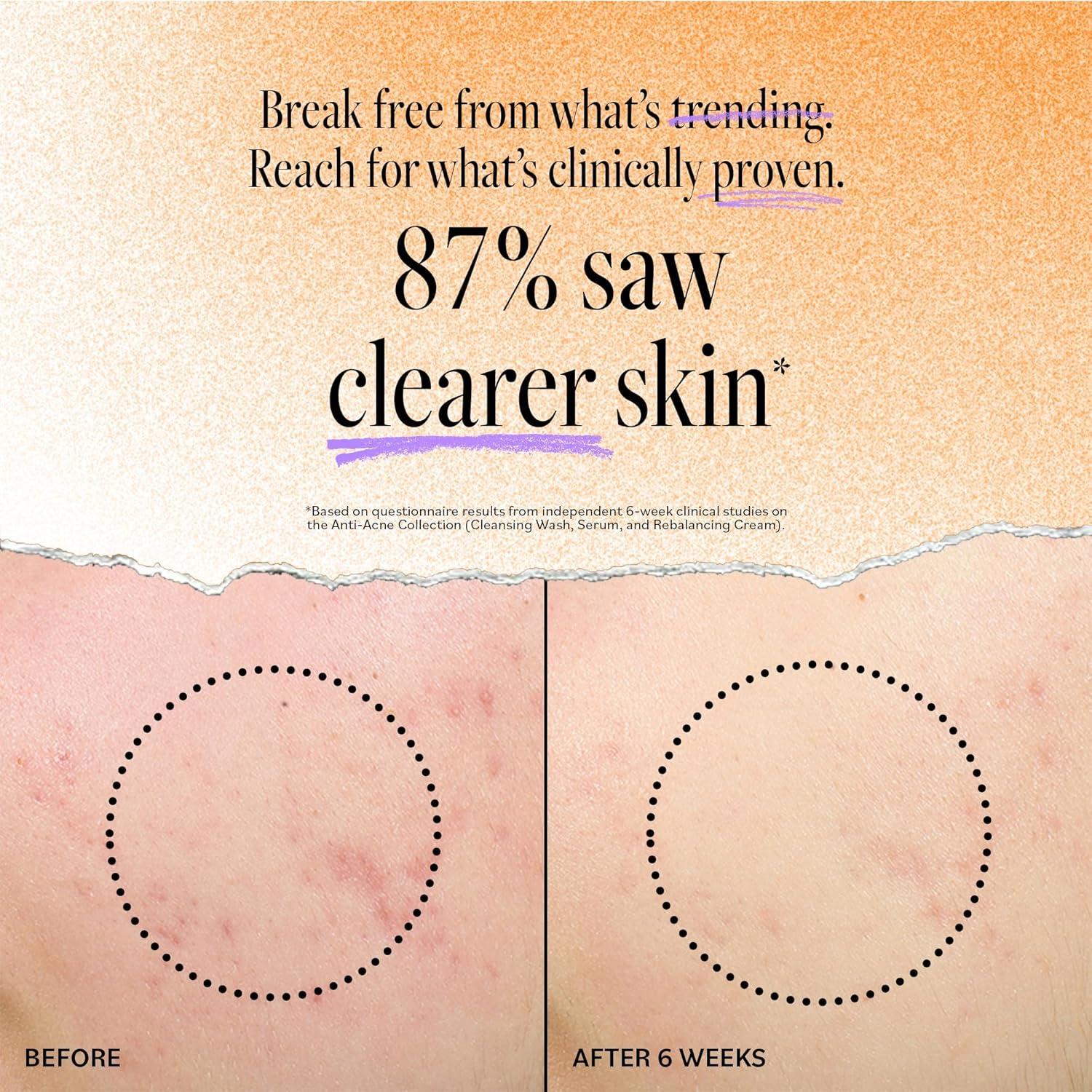 Limpiador Facial Derma E 177 ml - Control Acné con Ácido Salicílico