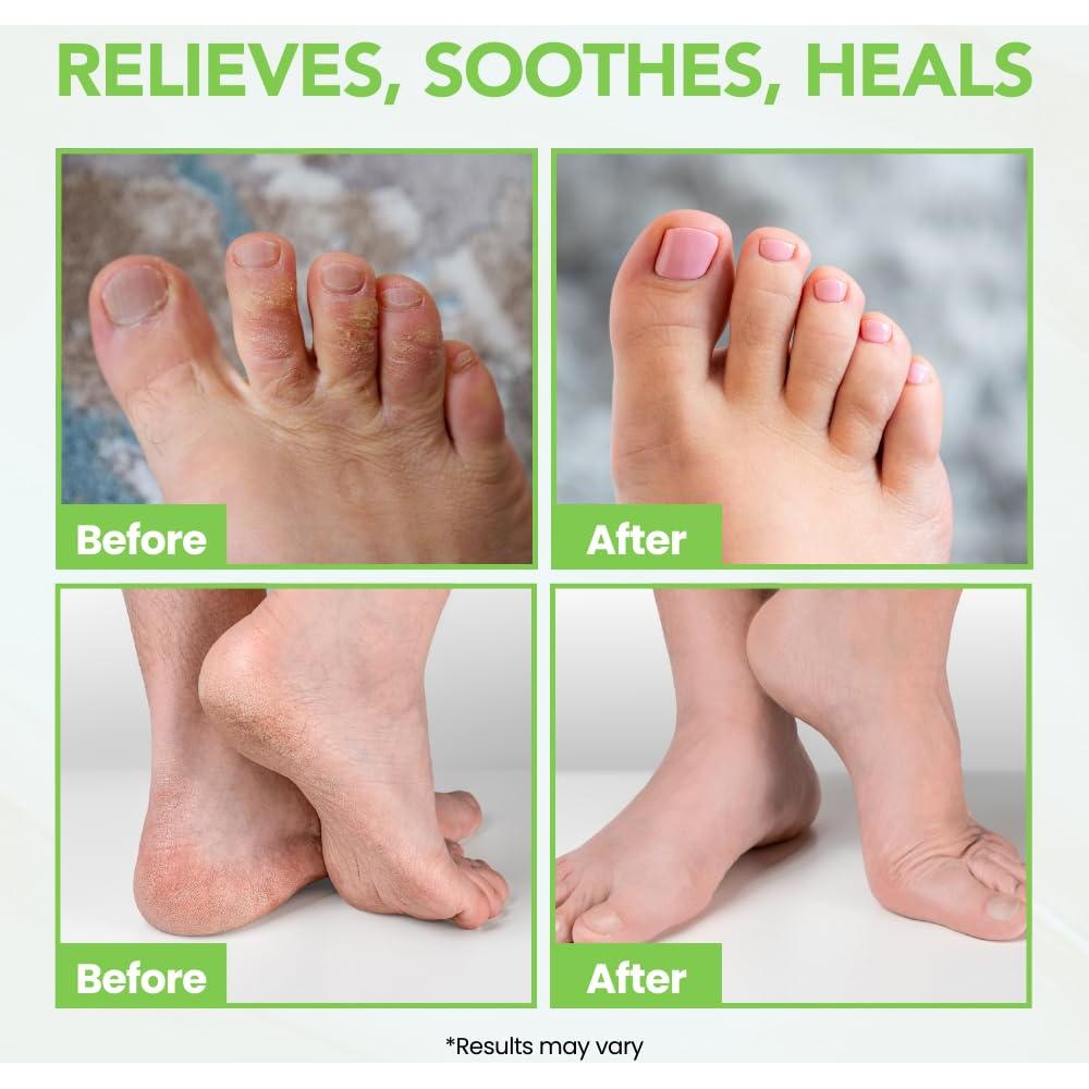 Bálsamo para Pies de Atleta THENA 140g - Alivio Rápido y Hidratación