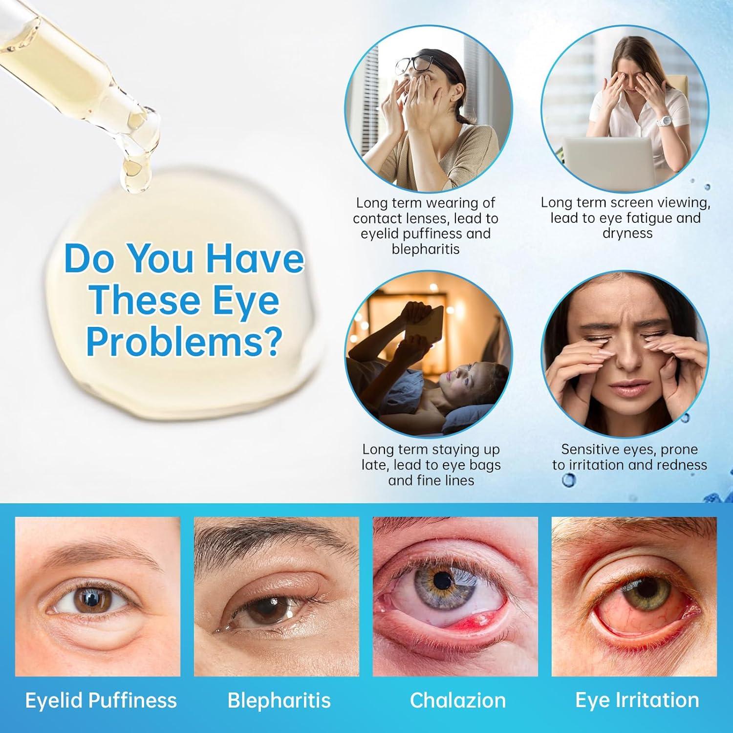 Suero para Ojos MIZEEYE 2 PCS - Tratamiento Chalazión y Blefaritis