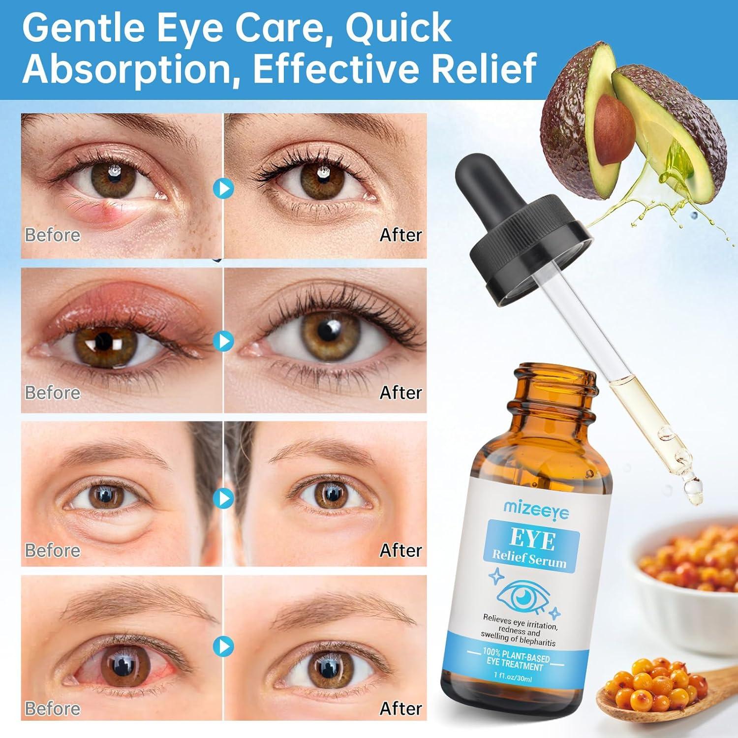 Suero para Ojos MIZEEYE 2 PCS - Tratamiento Chalazión y Blefaritis