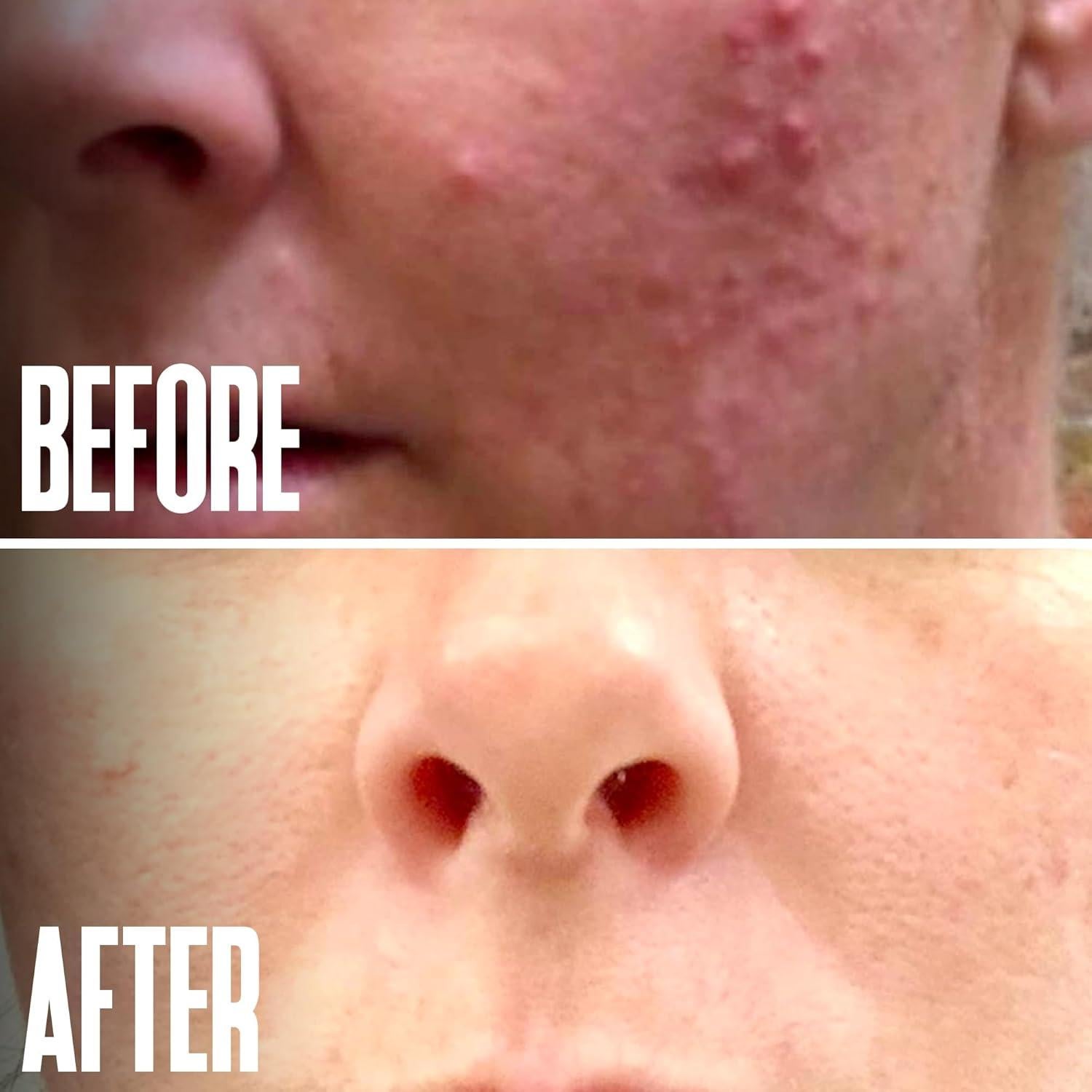 Peeling Químico Glicólico 40% Beautiste 30 ml - Exfoliante Facial