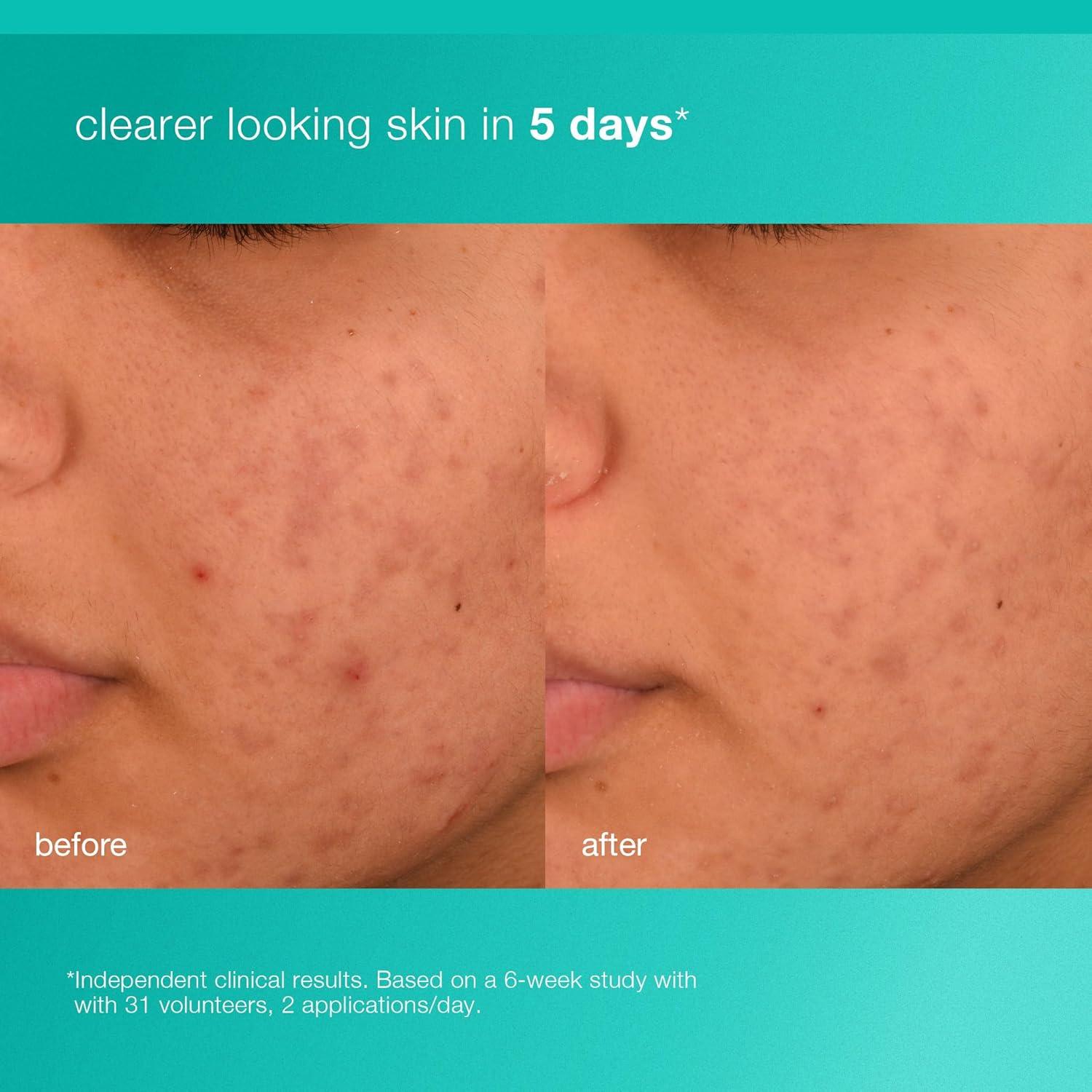 Hidratante Facial Acne Biotic Dermalogica 50 ml - Previene Brotes