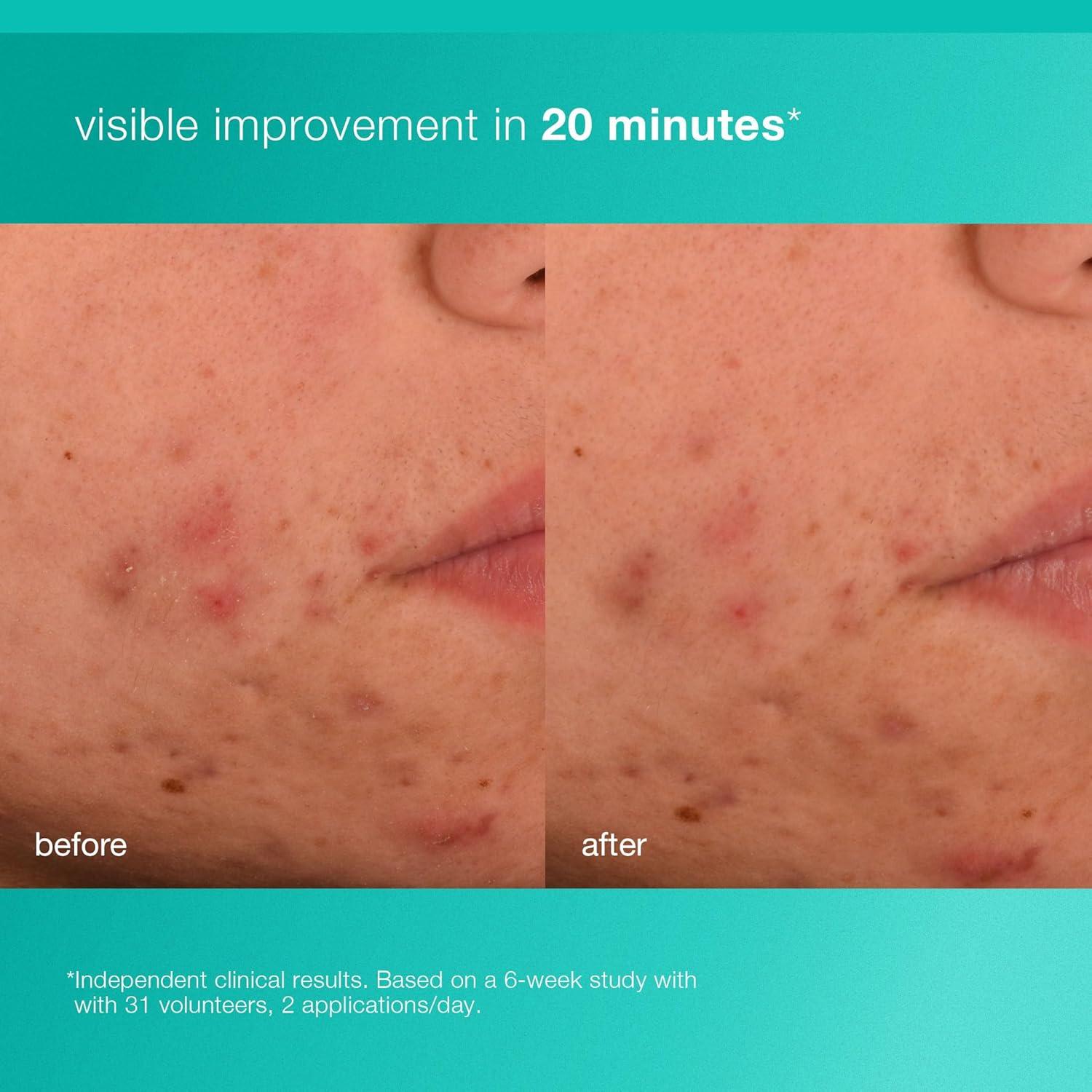 Hidratante Facial Acne Biotic Dermalogica 50 ml - Previene Brotes