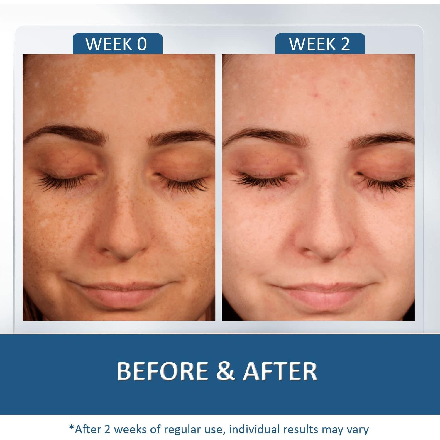 Crema Aclaradora Bye Bye - 100g, Elimina Manchas Oscuras