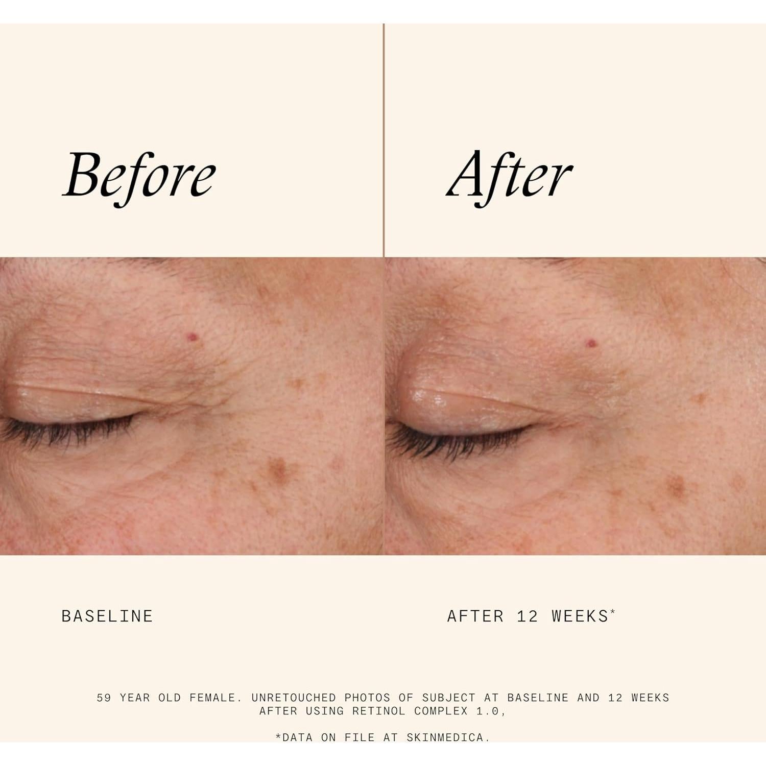 Suero de Retinol SkinMedica 1.0 - 29.57 ml, Antiarrugas