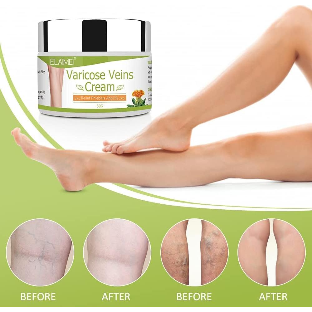 Crema para Venas Varicosas OTBK 150g - Alivio y Mejora de Piernas