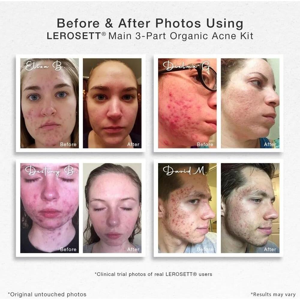 Kit para el Acné LEROSETT - Limpiador y Máscara Orgánica