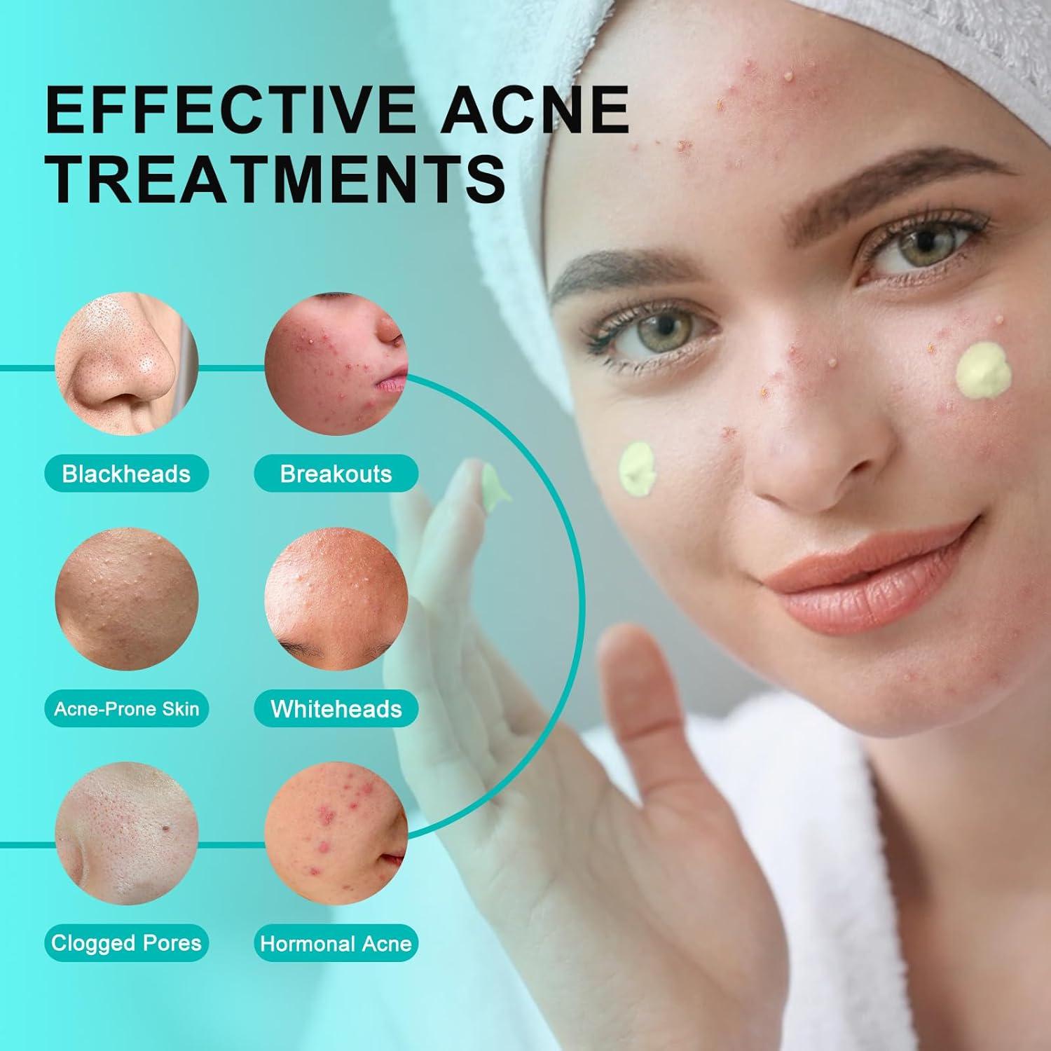 Crema Tratamiento Acné Quístico GUOYAOLIFU 132g - Natural