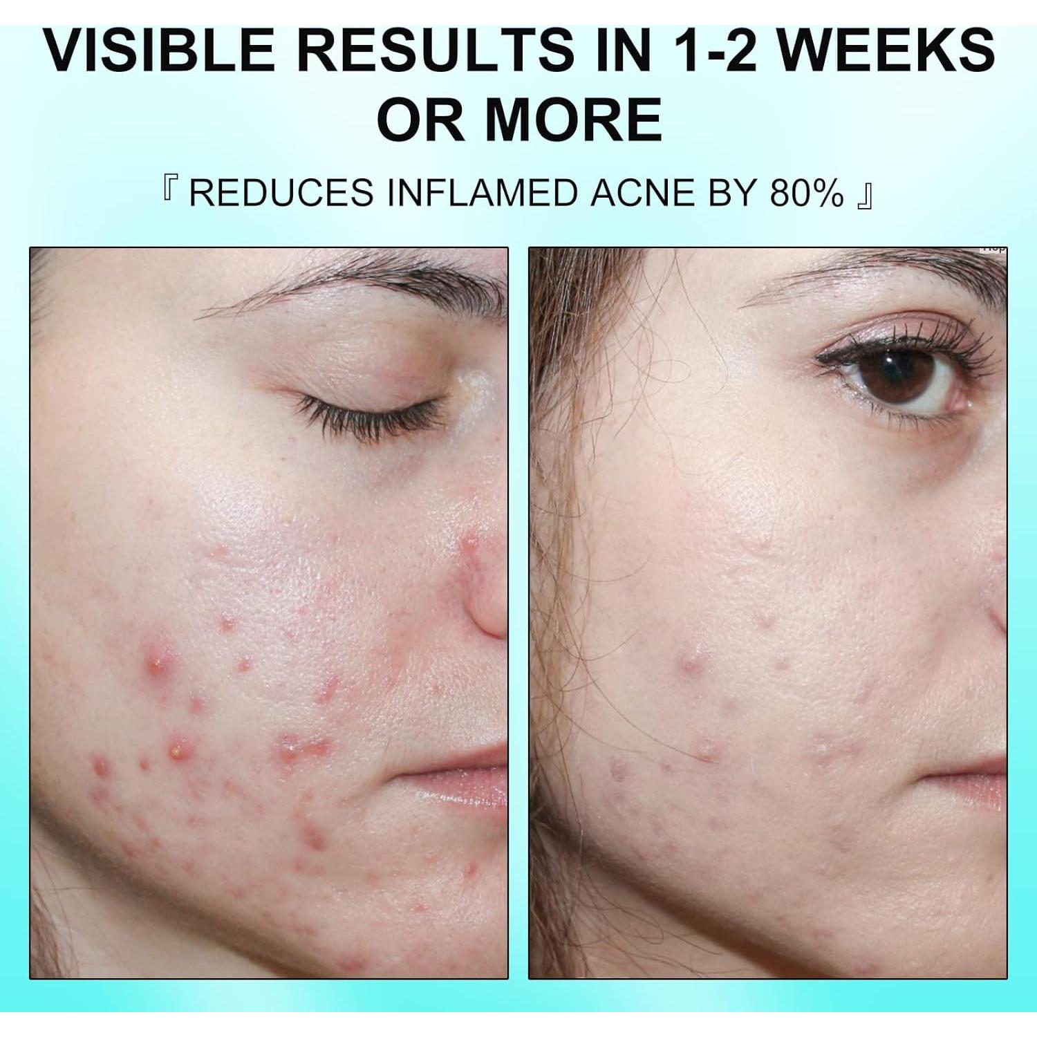 Crema Tratamiento Acné Quístico GUOYAOLIFU 132g - Natural