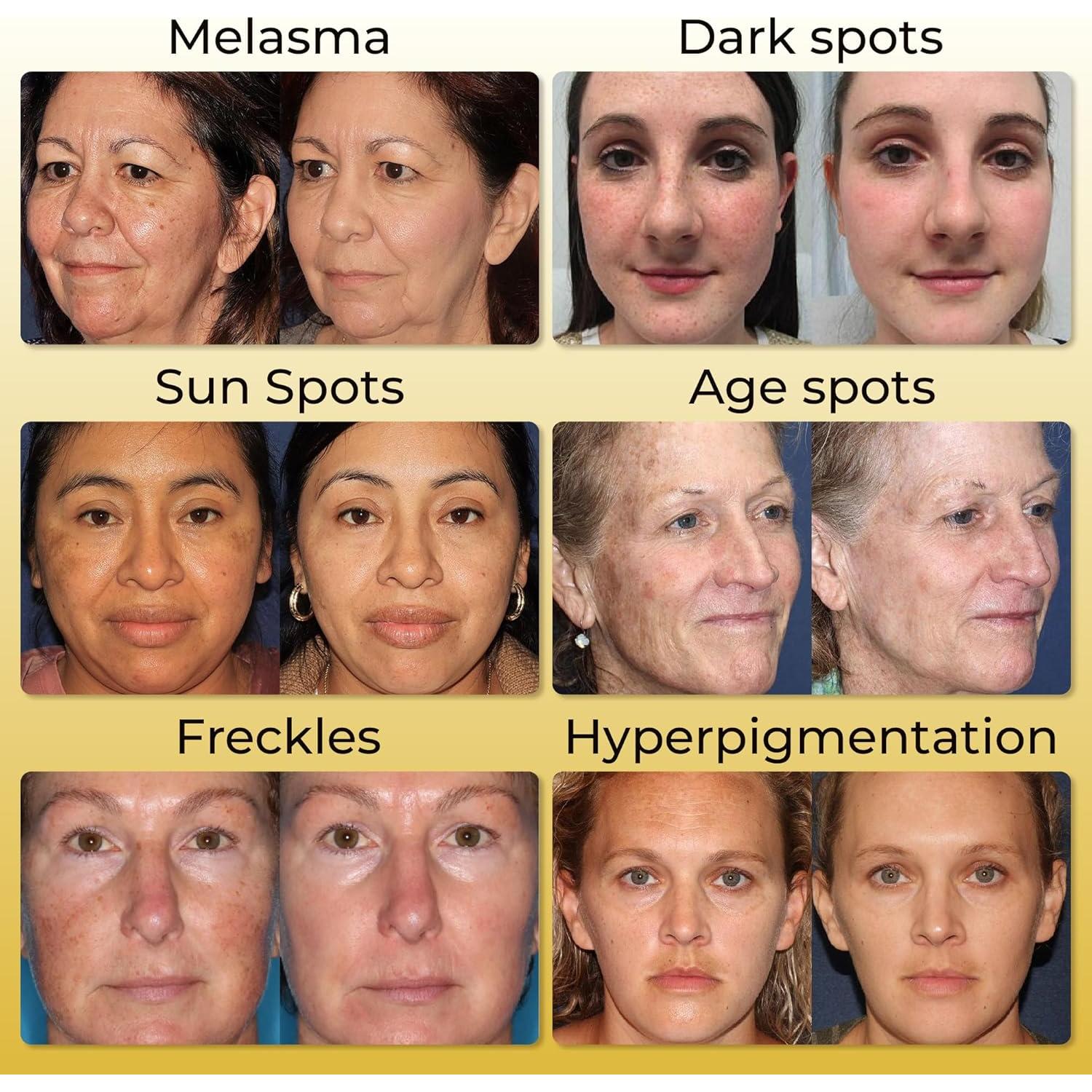 CREMA ABERA Kasumi para Melasma y Manchas Oscuras 19.84g