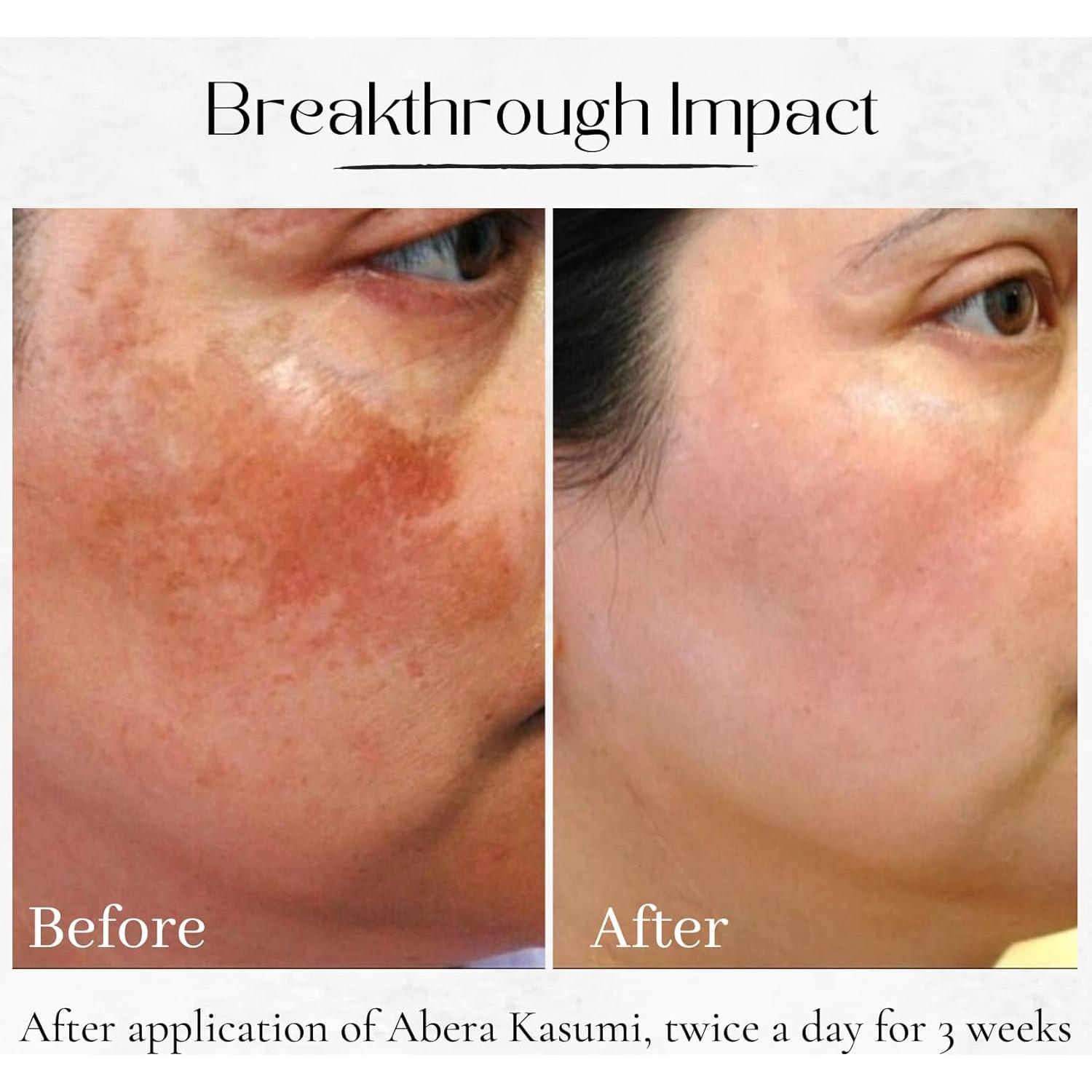 CREMA ABERA Kasumi para Melasma y Manchas Oscuras 19.84g