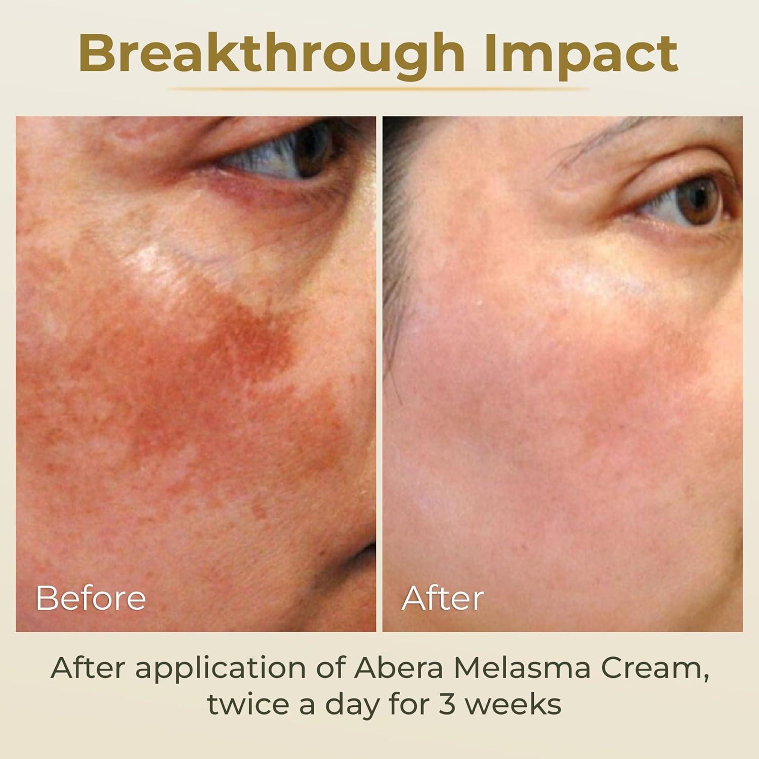 Crema Correctora de Manchas Oscuras Abera 19.84g - Melasma