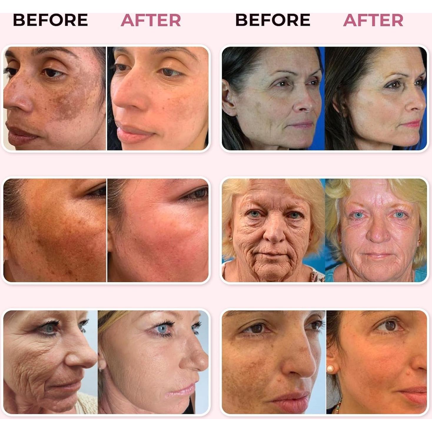 Suero Renovador de Piel ABERA 30 ml - Antienvejecimiento y Melasma