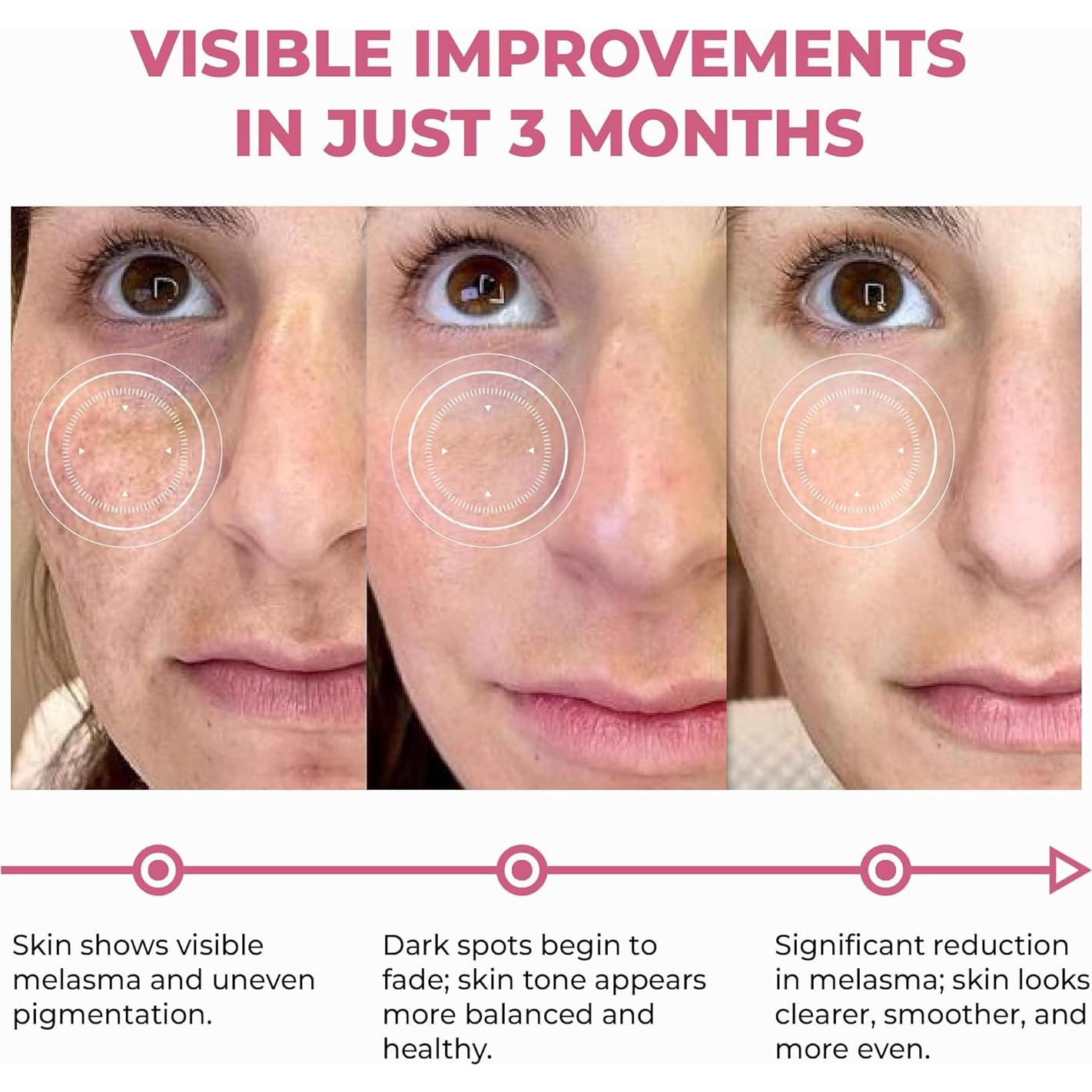 Suero Renovador de Piel ABERA 30 ml - Antienvejecimiento y Melasma