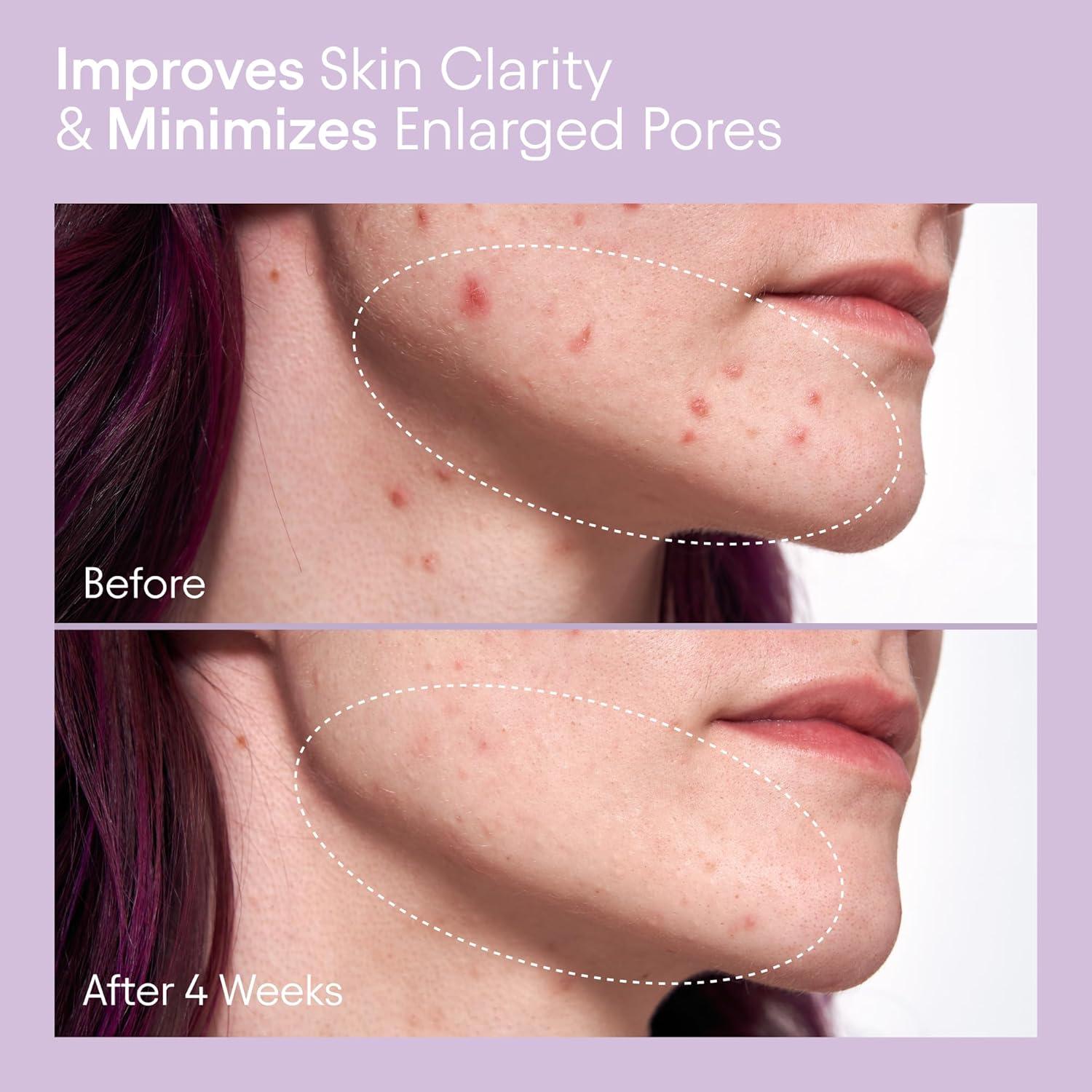 Tónico Líquido Exfoliante Alpyn 120 ml - 2% BHA y Borage