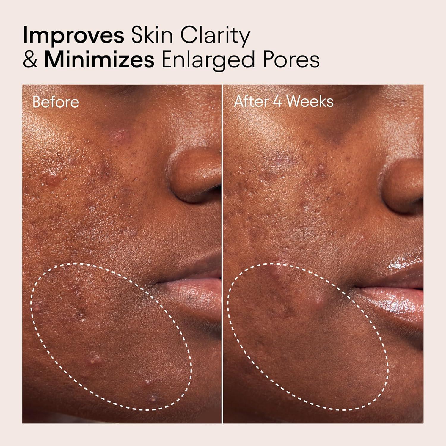 Tónico Líquido Exfoliante Alpyn 120 ml - 2% BHA y Borage