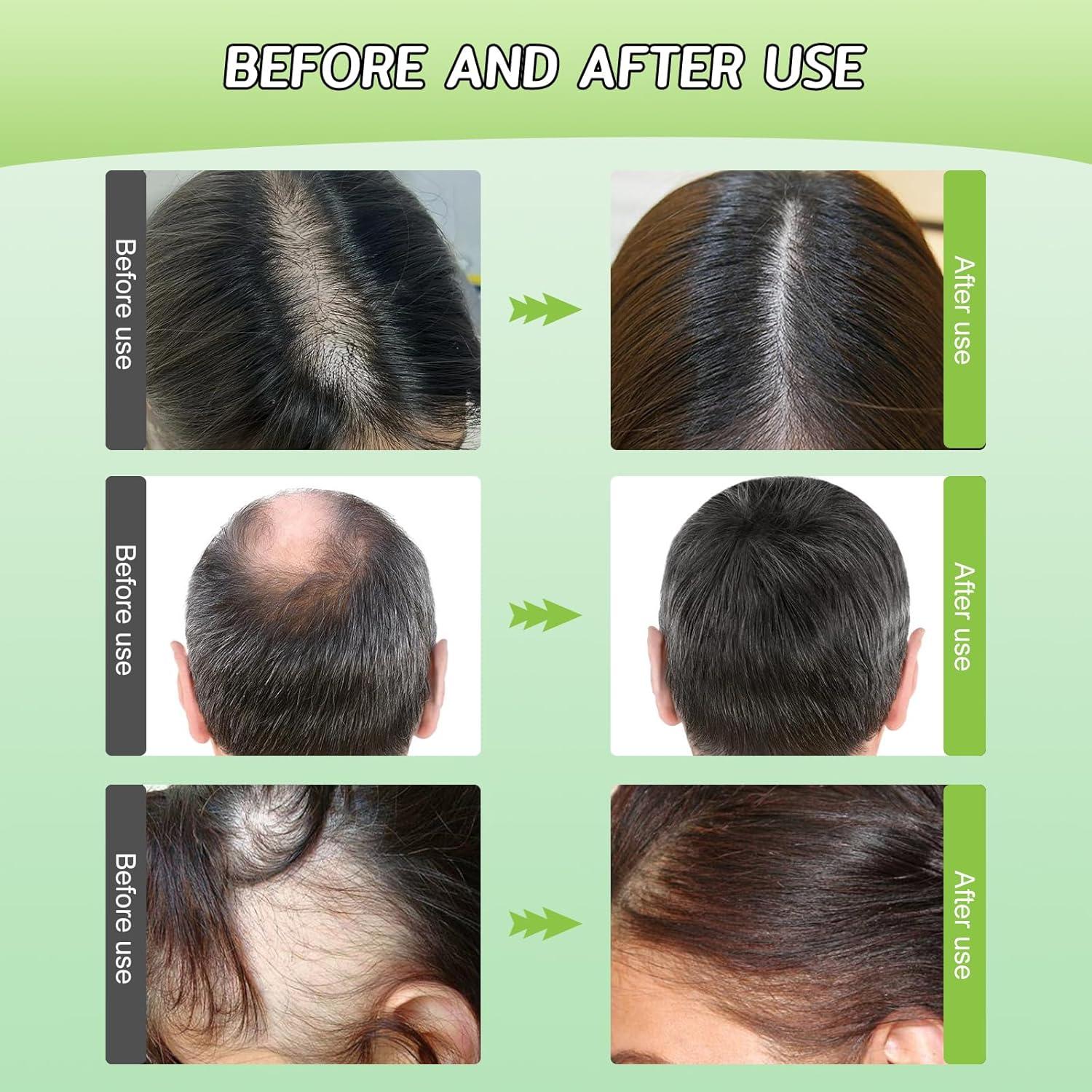 Champú Anticaída Yousheme con Extracto de Jengibre 40 Piezas