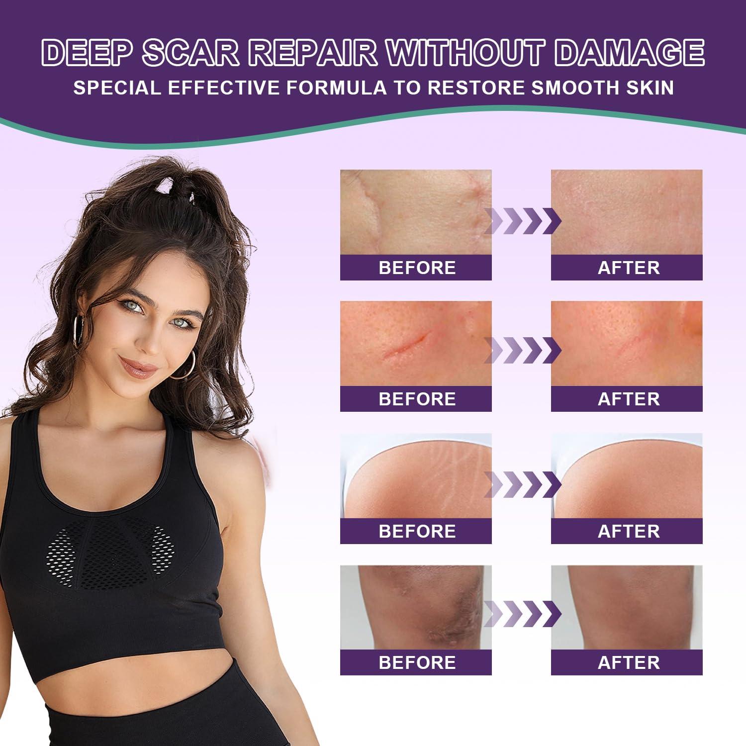 Crema de Cicatrices de Silicona Tearich 50g - Tratamiento Avanzado