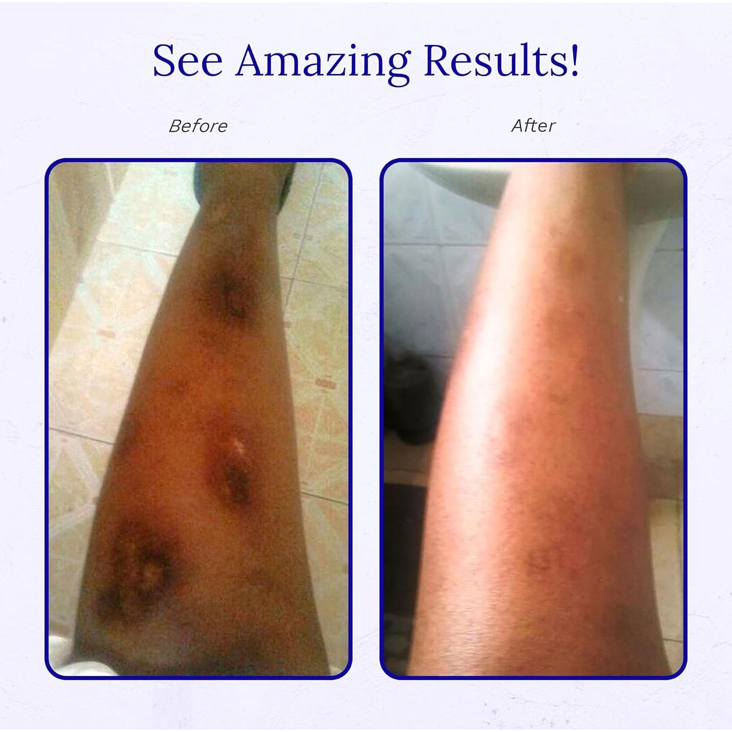 Crema para Cicatrices Rejuvaskin Scar Esthetique 10ml - Efectiva para Queloides y Estrías