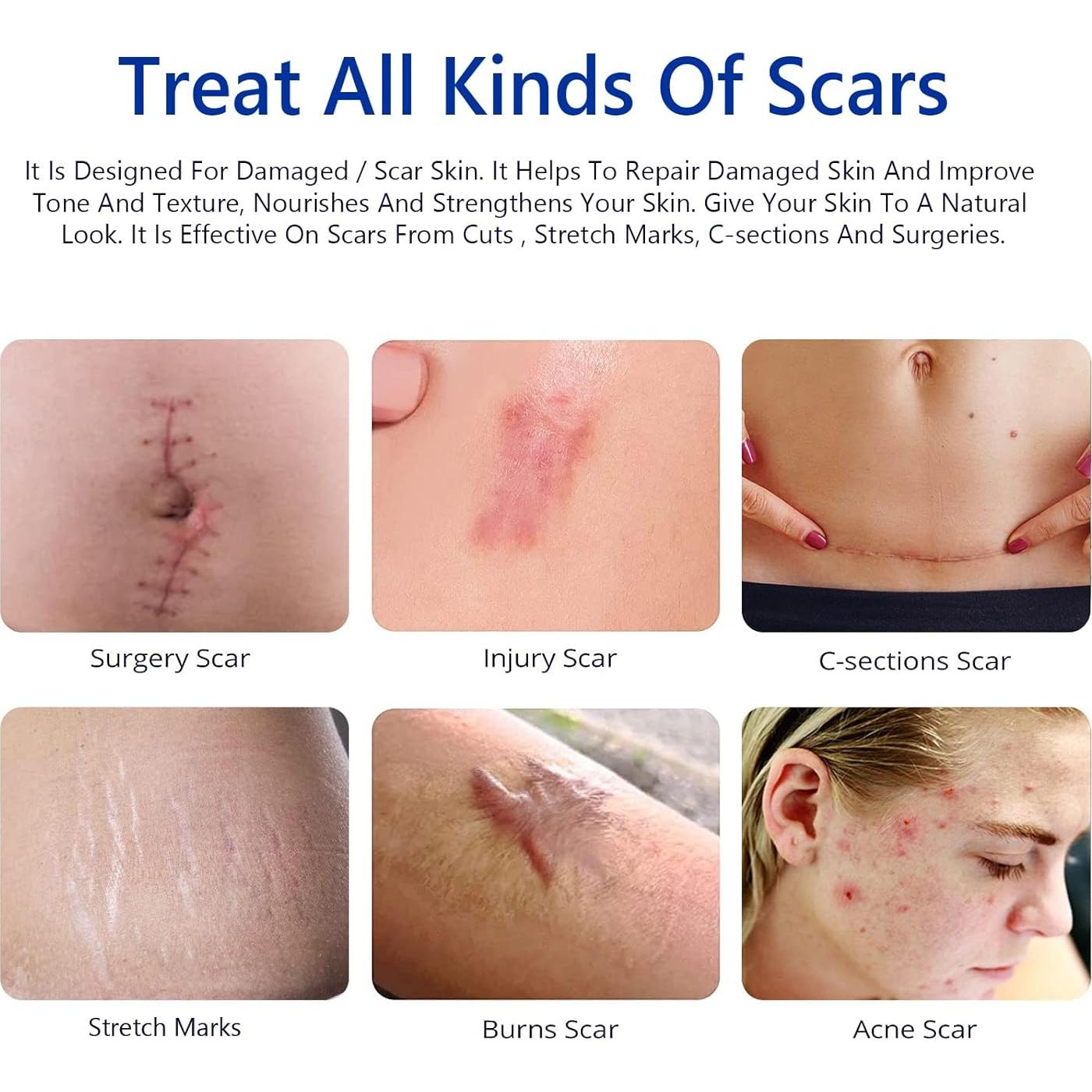 Crema para Cicatrices Writheion 159g - Gel Avanzado para Piel