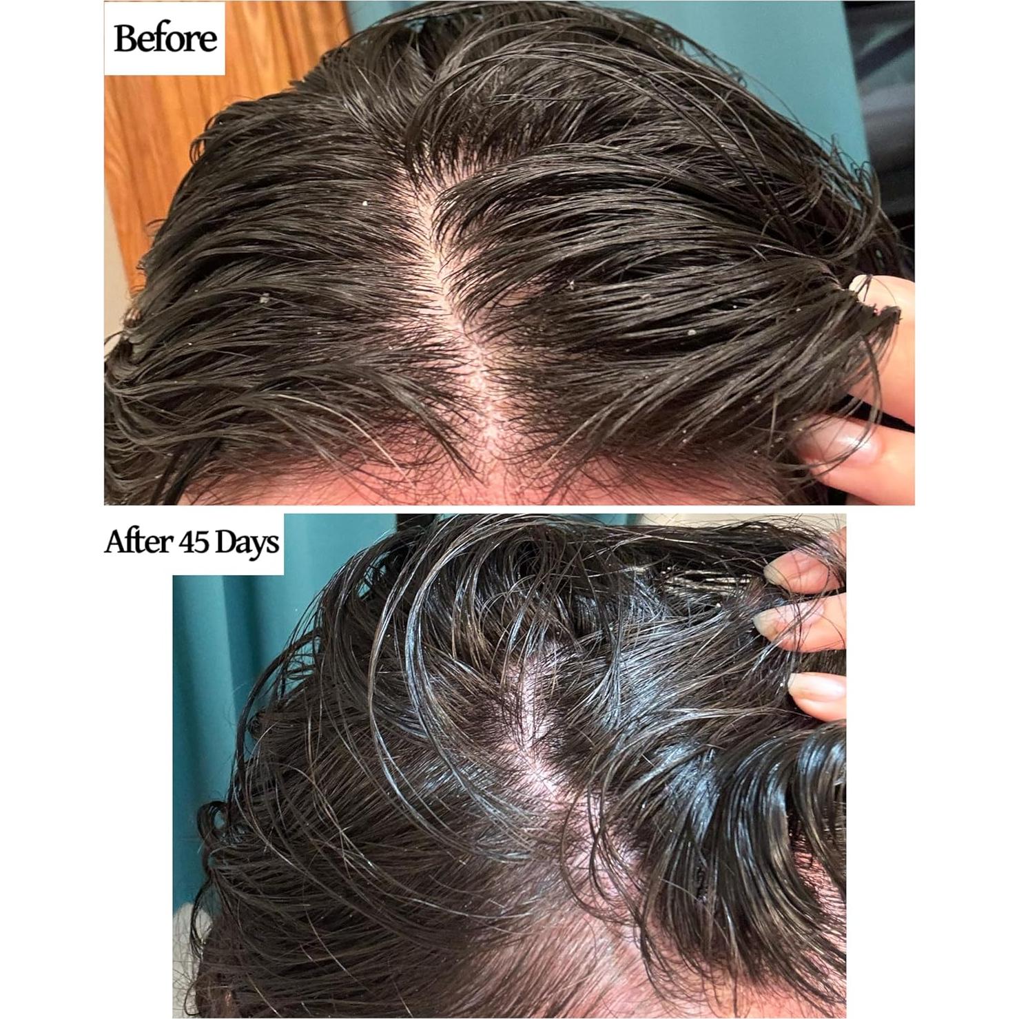 Set Aceite para Cuero Cabelludo y Cepillo Finalmente 368g