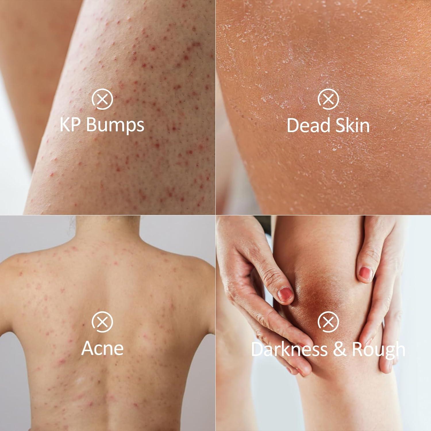 Exfoliante Corporal Kp Bump Eraser 300g con AHA y BHA