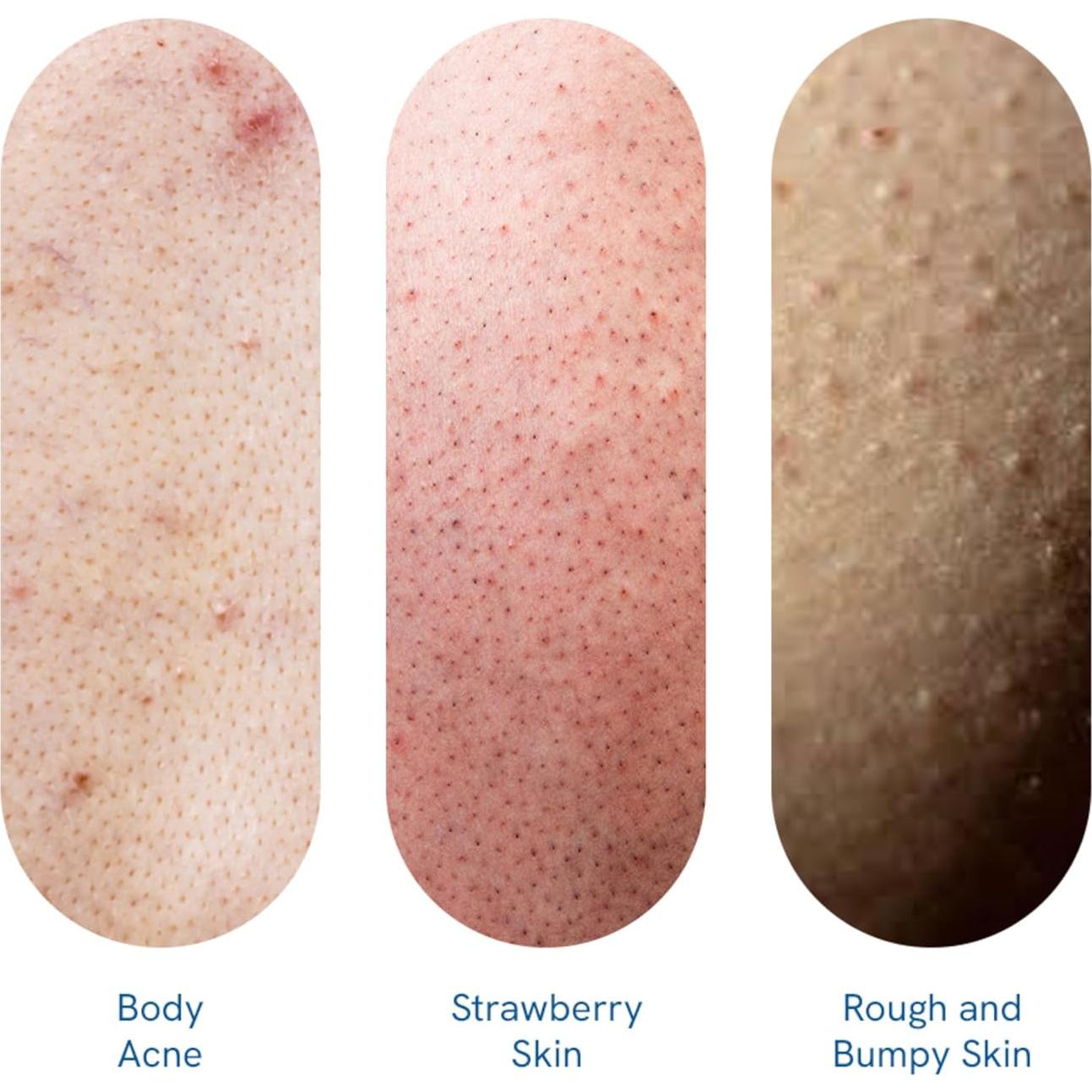 Gel de Ducha Be Bodywise 1% Ácido Salicílico 250ml