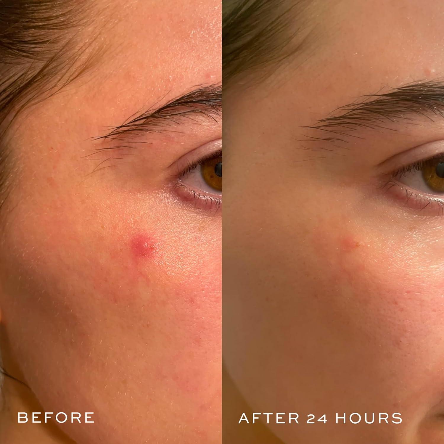 Parche Hidrocoloide DIME Beauty Power Patch 72 Unidades