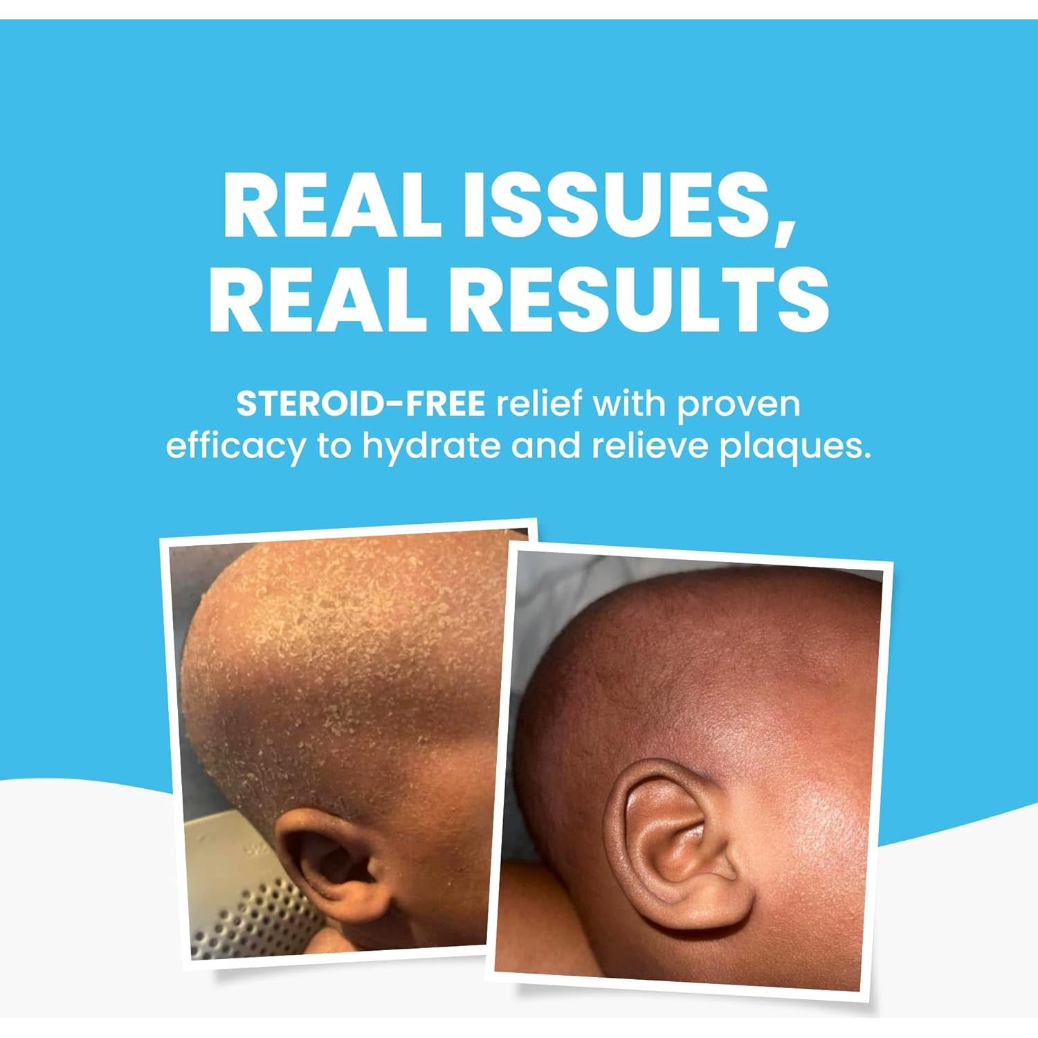 Aceite Corporal y de Baño Grahams para Bebés 95g - Eccema y Costra Láctea