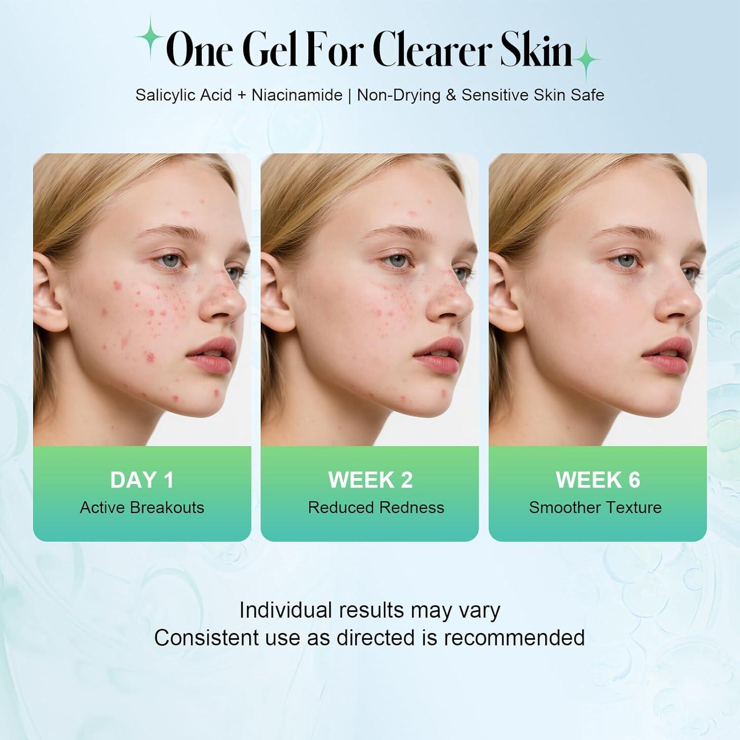 Gel Tratamiento Acné Ácido Salicílico 2% TRSTAY LUXE 10.4 ml