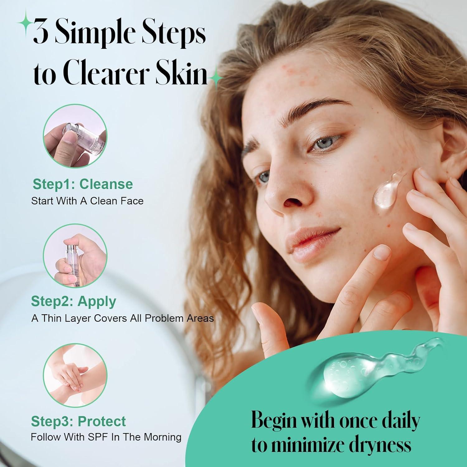 Gel Tratamiento Acné Ácido Salicílico 2% TRSTAY LUXE 10.4 ml