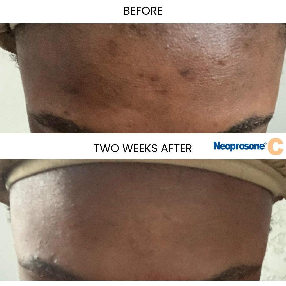 Suero de Vitamina C Neoprosone 30ml | Iluminador Antiarrugas