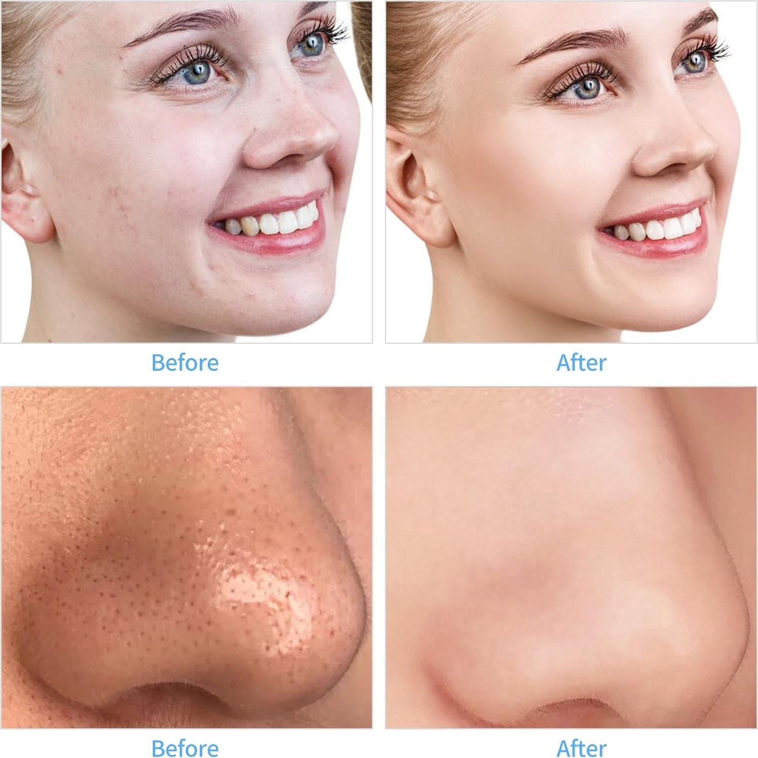 Máquina de Microdermoabrasión Profesional mcwdoit Portátil