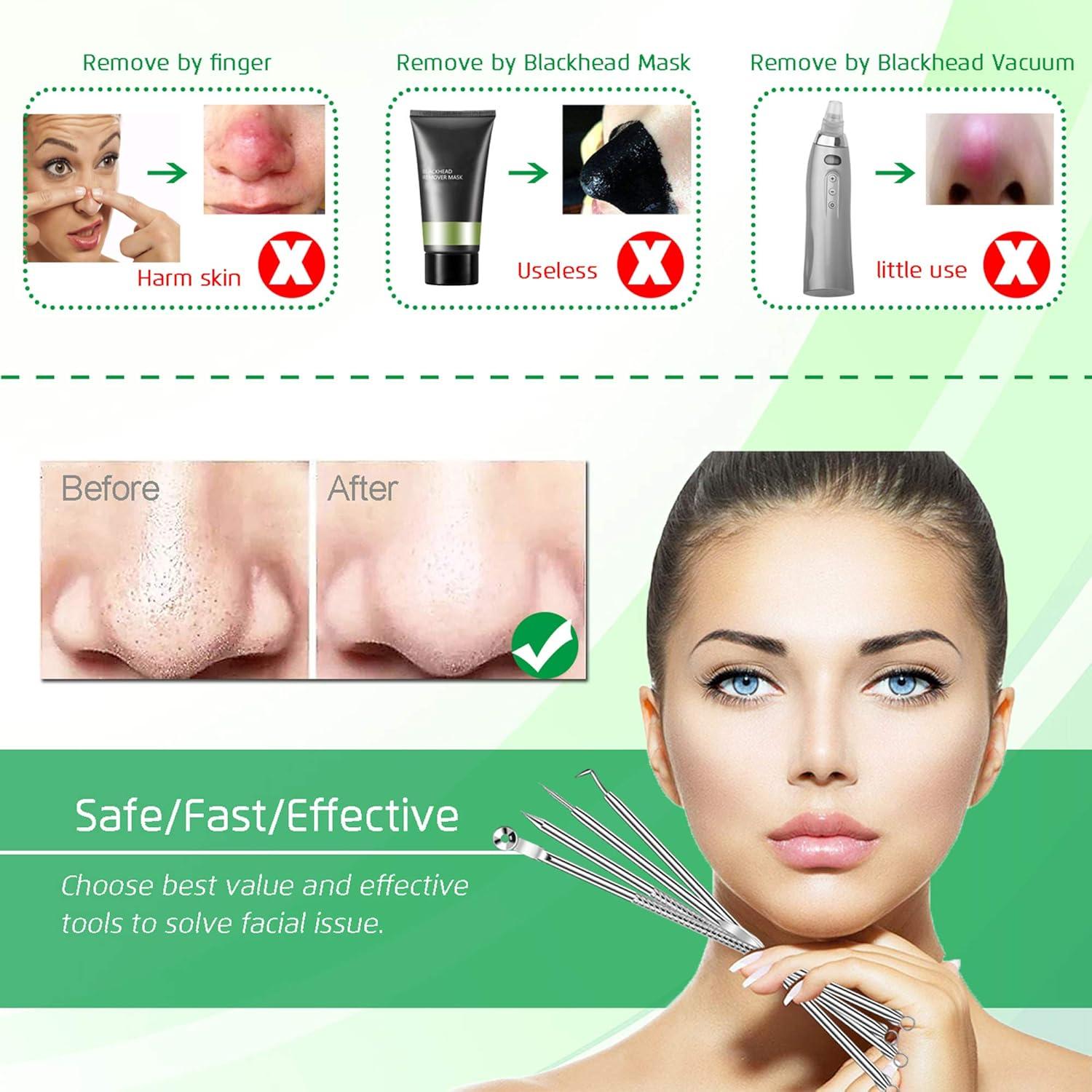 Kit Extractor de Comedones 5 Piezas Kotomotoy Acero Inoxidable