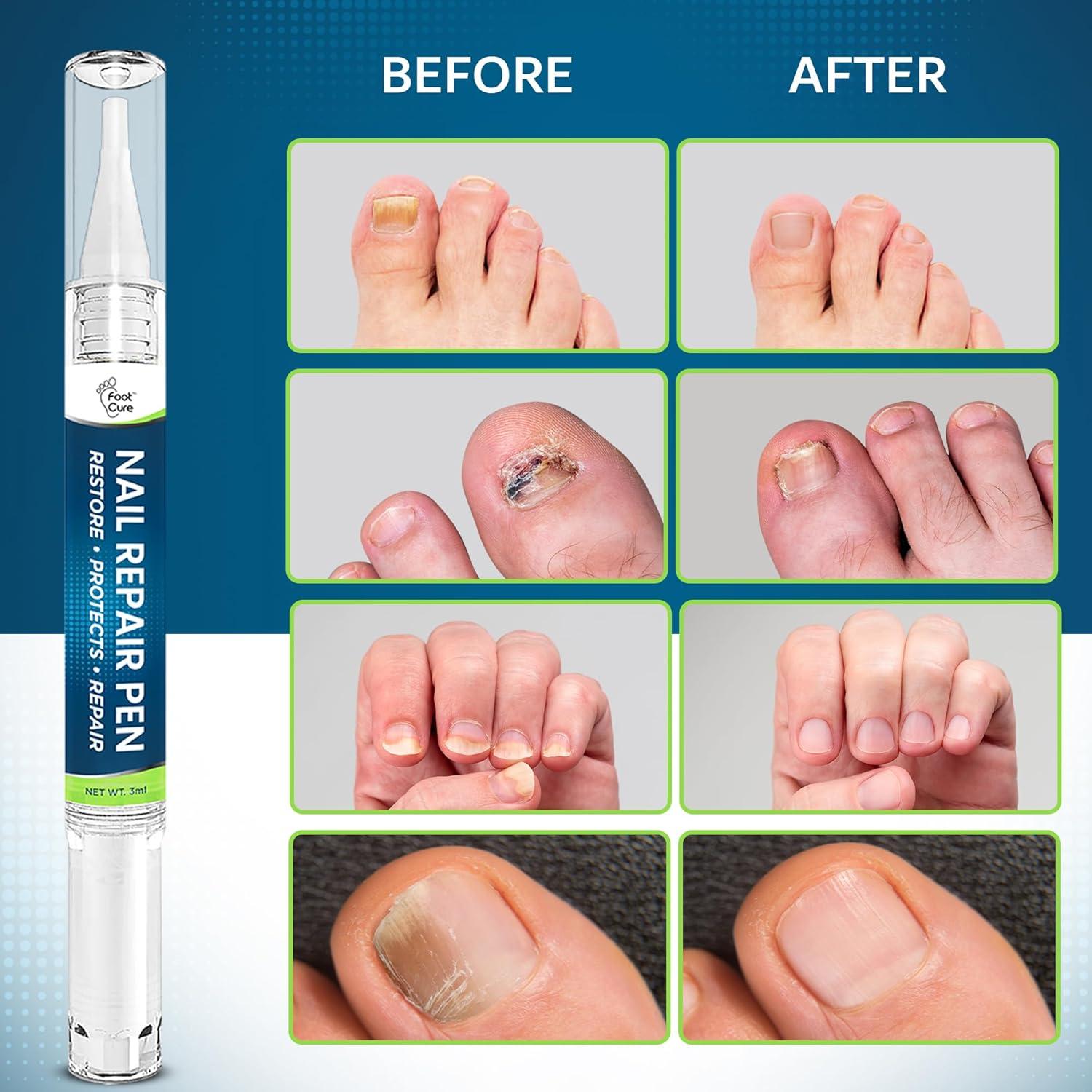 Bolígrafo Antifúngico FOOT CURE 2-Pack 25% Ácido Undecilénico