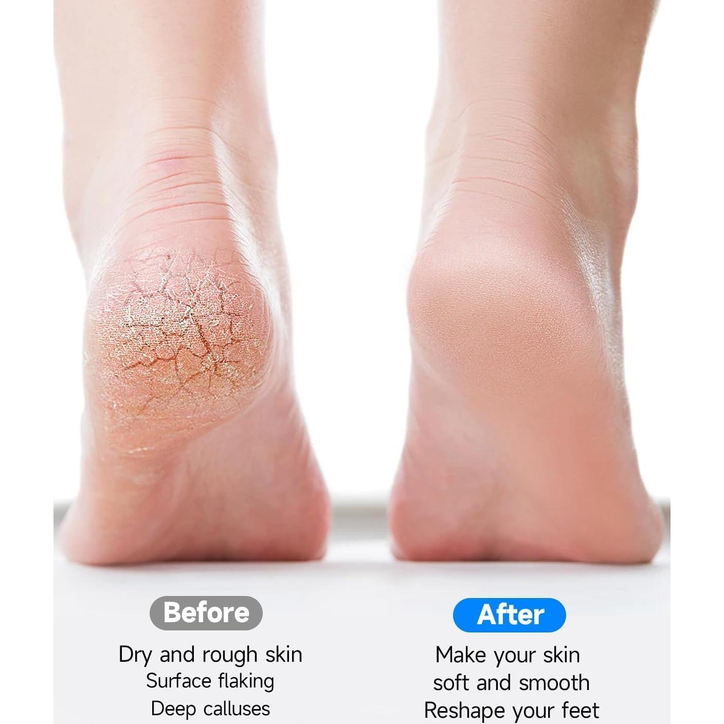 Removedor de Callos Eléctrico Weini A1 Recargable IPX6