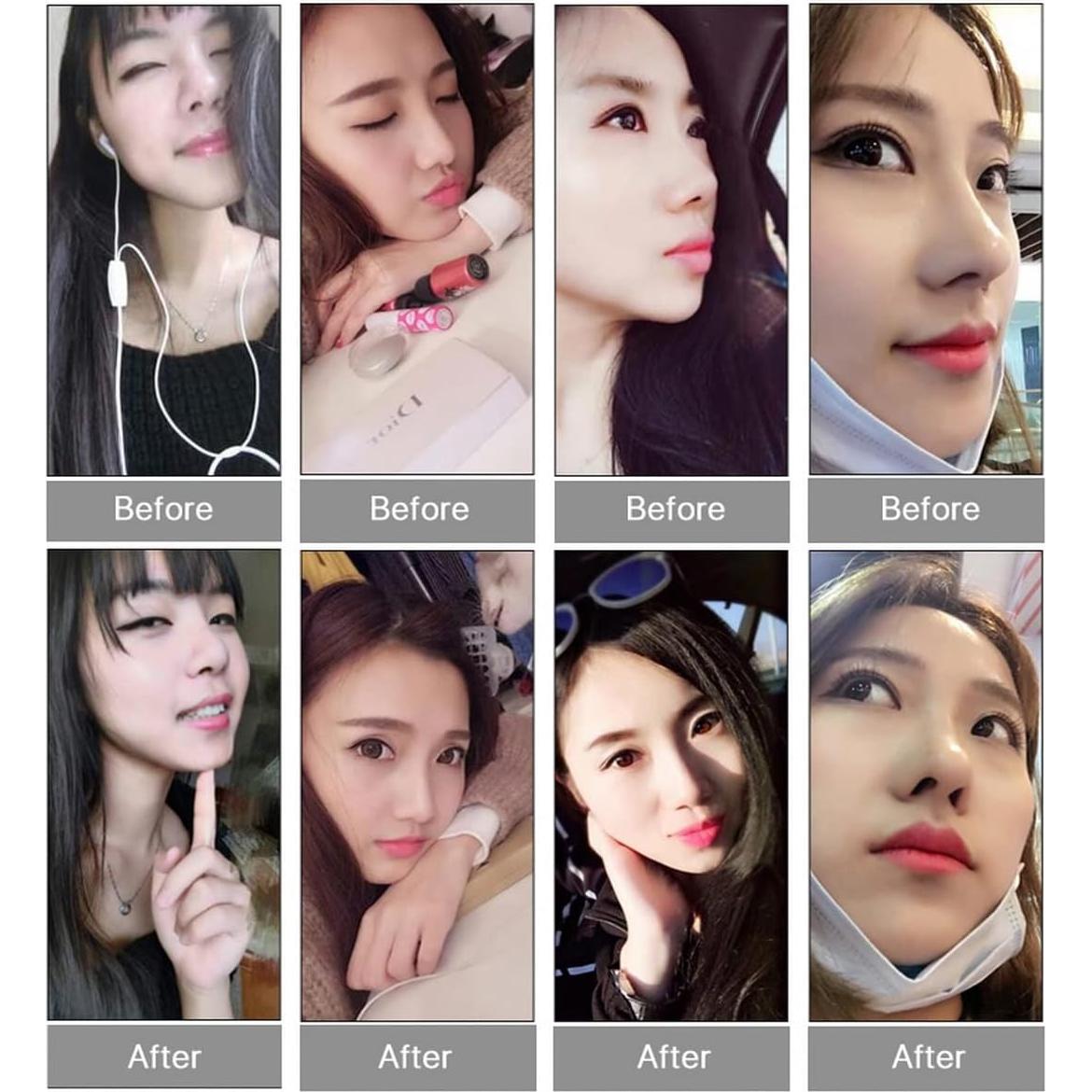 Elevador de Nariz Invisible VANANA - 3 Tamaños de Silicona