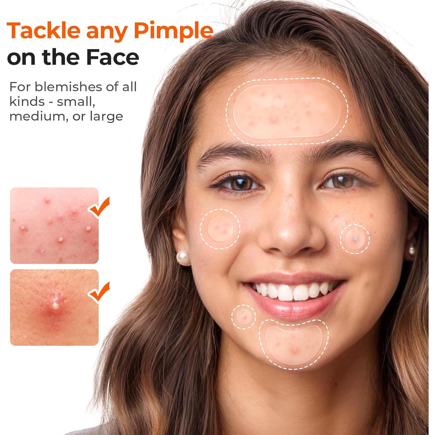 Parches para Acné TKTK Hidrocoloides 443 Piezas 5 Tamaños