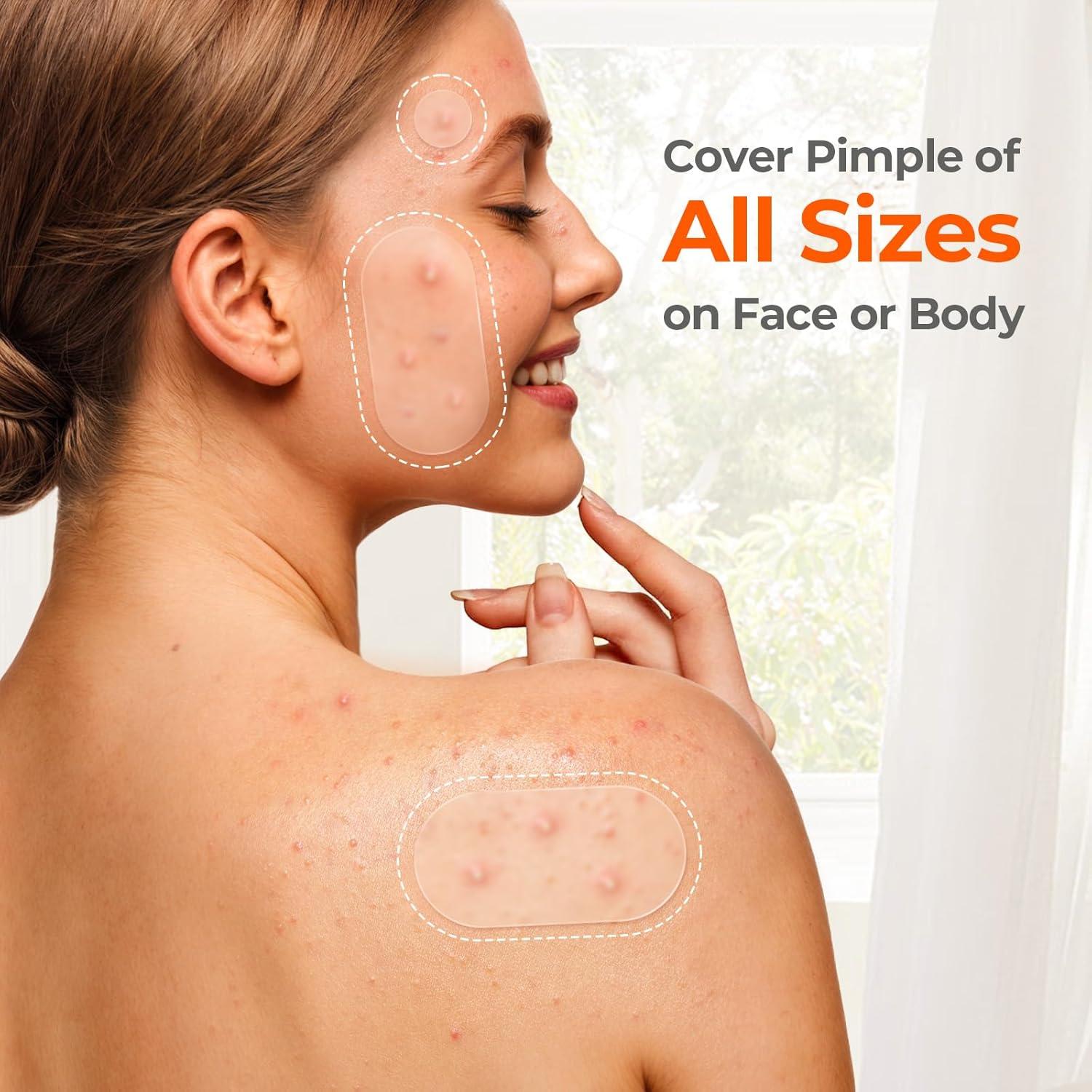 Parches para Acné TKTK Hidrocoloides 443 Piezas 5 Tamaños