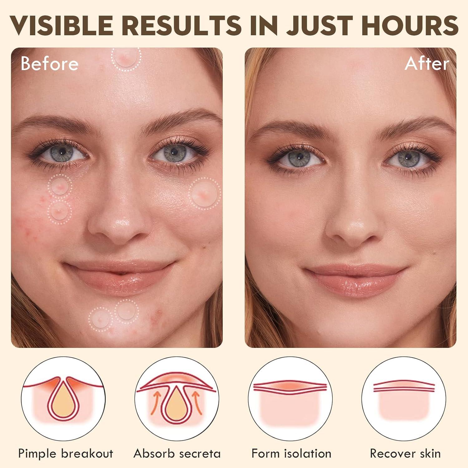 Parches para Granos Blorfo - Hidrocoloides 144 Unidades 9mm/12mm