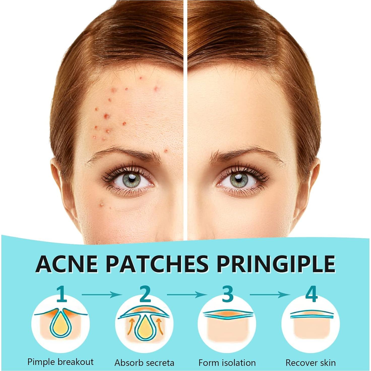 Parches Hidrocoloides para Granos PICcircuit - 360 Unidades