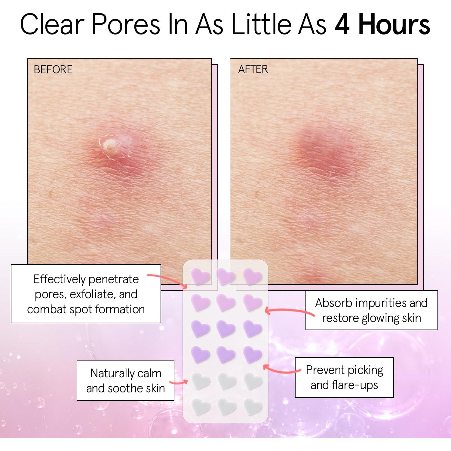 Parches para Granitos Grace & Stella - Hidrocoloides Corazón 36 Unidades