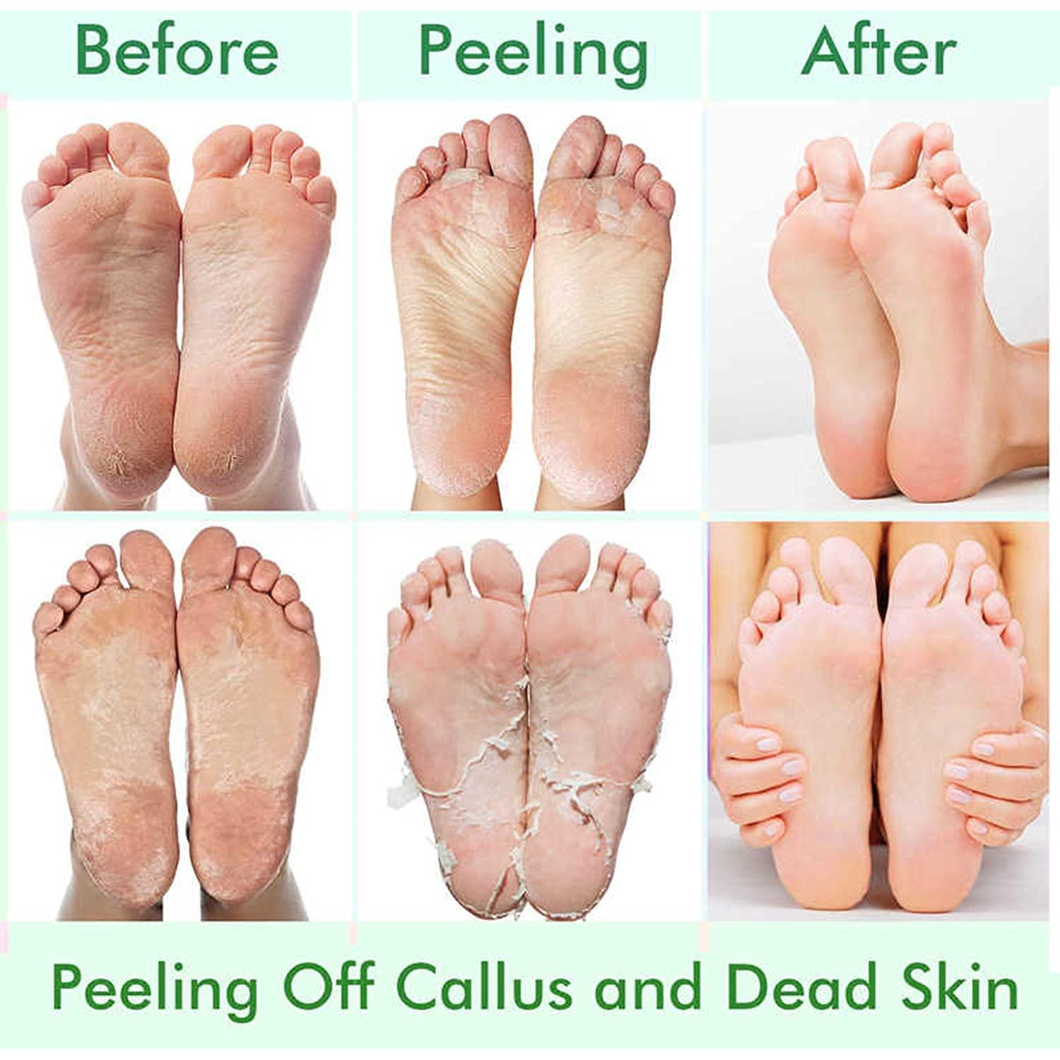 5 Paquete Máscaras Exfoliantes para Pies CMWGKBC - Hidratación