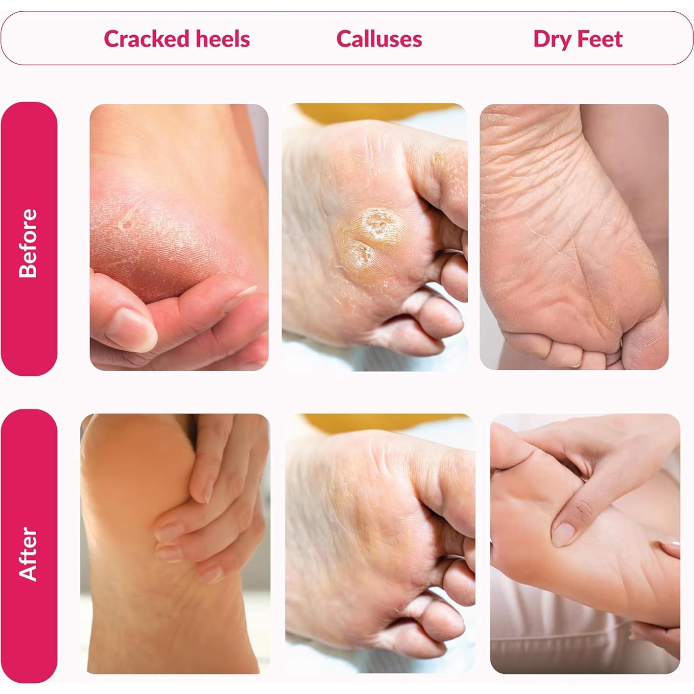 Mascarilla Exfoliante para Pies Summer Foot - 2 Pares con Urea