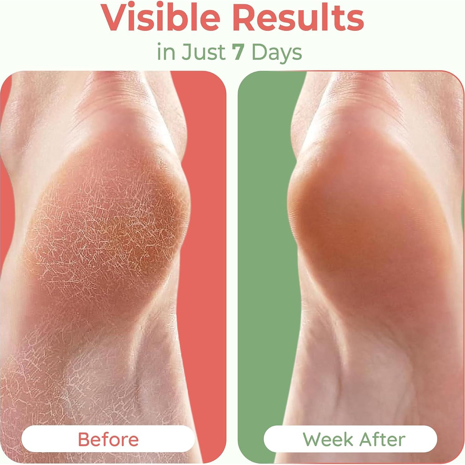 Calcetines hidratantes PhysFlex para talones agrietados - Gris