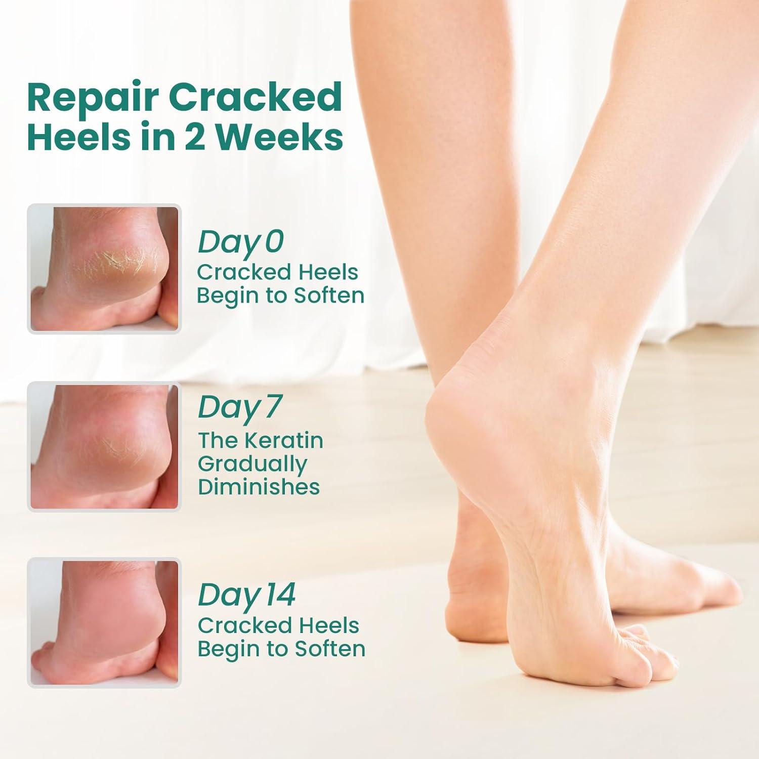 Calcetines Hidratantes Welnove para Talones - 2 Pares con Aloe Vera