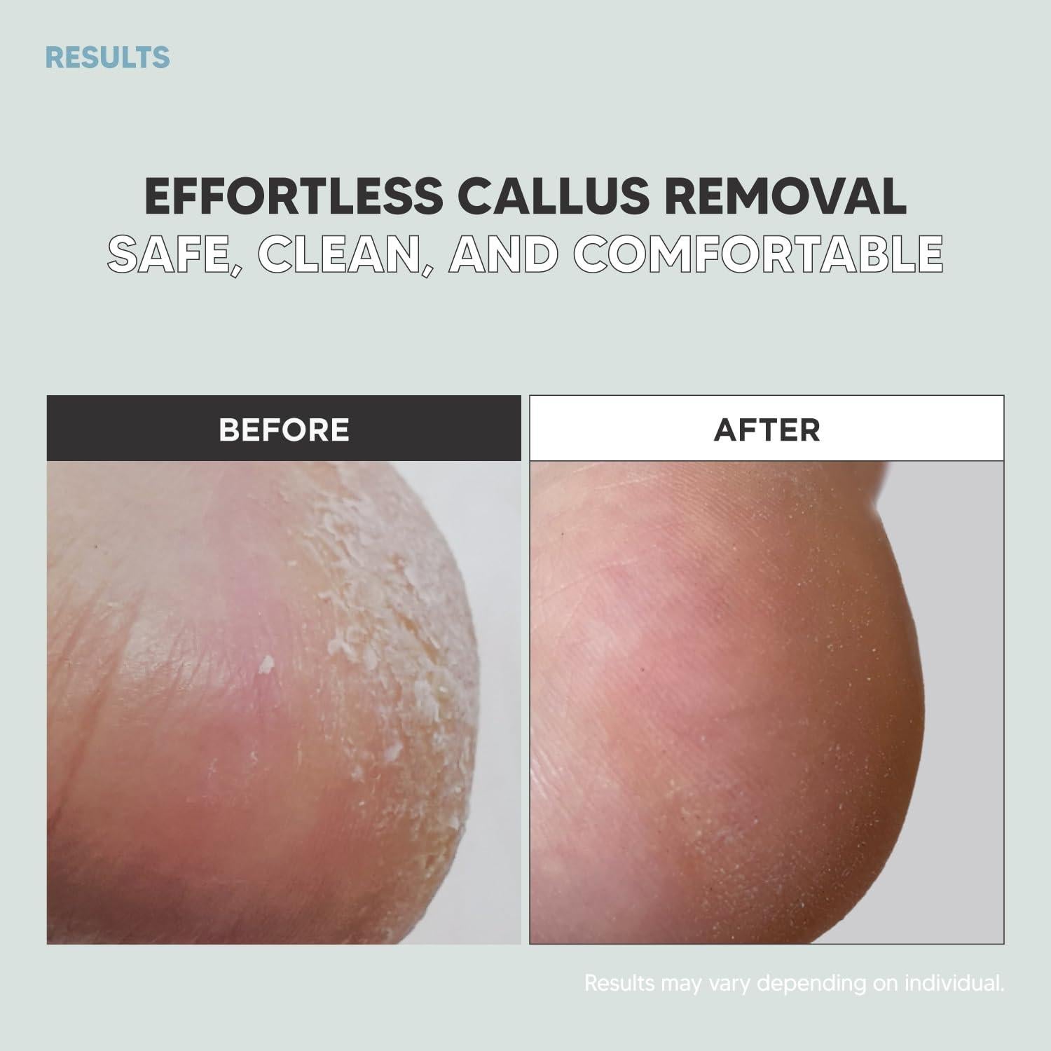 Raspador de Callos F3 Systems - Acero Inoxidable, 3 Piezas